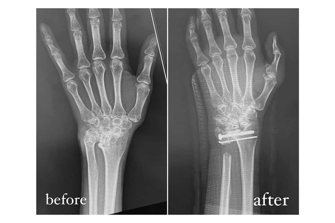 荻原桃子さんのインスタグラム写真 - (荻原桃子Instagram)「手の手術の話💭  私は昔から若年性リウマチという持病がありましてもう人生の半分くらいこの病気と付き合っているのですが  リウマチというのは、関節が炎症を起こし、自らの力で軟骨や骨が破壊されて関節の機能が損なわれ、放っておくと関節が変形してしまう病気です。  私の症状は両手首だけではあるのですが 手首の骨が少し出っぱったように変型していて その影響で両手首をひねったり、支えたりする動きが出来ない状況でした (とは言え日常生活にはそこまで影響は無い。固いペットボトル開けられなかったり、腕立て伏せやスノボーなど手首で身体を支えたりする事が出来ない。)  更にはその手首の骨に擦れて 指の腱が左は薬指と小指、 右は小指が切れてしまっていて (腱が切れると指は曲がるけど 上に上げたり横に動かす力が入れられなくなってしまう)  さすがにちょっと日常生活に支障が出てきまして、、、  ずっと悩んでいたのですが 今回意を決して切れてしまった指の腱を中指に繋げて 変型して回りづらくなった手首の骨を除去するという手術をしました😌  まだまだ術後2日目でギプスに慣れず 手がパンパンに腫れて片手しか使えない自分に戸惑っている時期なのですが  もうすぐこの状況にも慣れて ギプスファッション楽しみながら  軽やかに手を動かせる日を楽しみにしております🙋‍♀️  ちなみにギブスじゃなくてギプスらしい💭知らなかったw  リウマチの手術の事調べても 詳しい情報少なかったので Youtubeにもまとめて誰かの参考になったら良いなぁと 動画撮り溜めてるので 無事にギプス取れたらUPします！  #若年性リウマチ　 #リウマチ　#リウマチ治療」1月13日 22時03分 - momokoogihara
