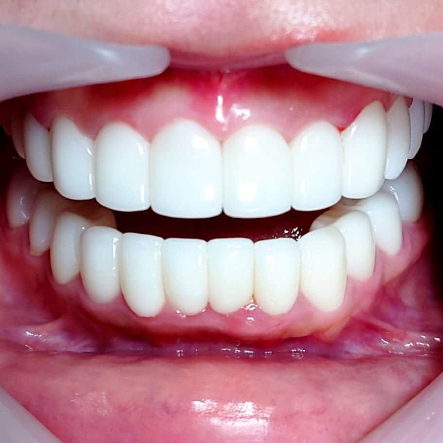 五十嵐一誠さんのインスタグラム写真 - (五十嵐一誠Instagram)「セラミックの技術の上手さを 見抜くポイント教えます  セラミックと歯茎の境目に 注目してください  このポイントが綺麗で自然な 出来は技術が高いです  多くの審美歯科や美容歯科の 症例写真は この部分を写してなかったり 見えないようにしています  チェックしてみてください  #審美歯科#美容歯科#歯医者 #セラミック#前歯#歯#歯科 #美容#整形#美人#エステ#ヨガ #フィットネス#ヘアサロン #小顔#ベニア#矯正#キャバ #ホワイトニング#夜職#クラブ」1月16日 16時24分 - superdentist5