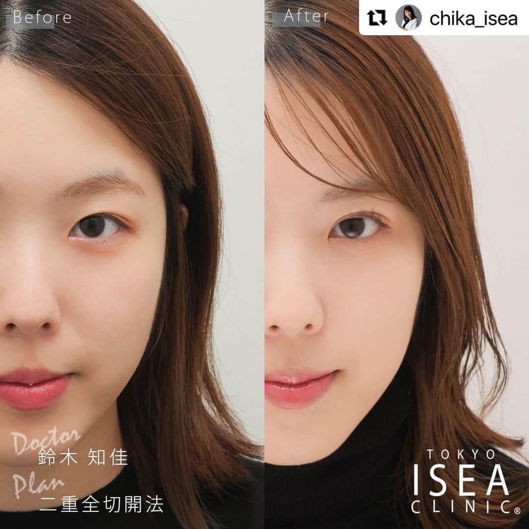 のインスタグラム：「■ 二重全切開法 ■  執刀医 ▶︎ 鈴木知佳 @chika_isea   #Repost @chika_isea with @make_repost ・・・ 【施術の詳細】 🕐手術時間 ・・・約60分 👁ダウンタイム・・・約2週間 📆完成まで ・・・約3か月 🏥術後の通院　・・・5日～7日後に抜糸 . 【全切開法とは？】 まぶたの幅（３～４cm程度）をメスで切開し、 くっきりとした半永久的な二重を作る方法です。 . 【こんな方におすすめです！】 ✔️まぶたが厚い ✔️埋没法より戻りにくい方法を選びたい . 【全切開法の保証について】 ・デザイン変更 完成後1ヶ月以内であれば、二重幅変更の再手術が可能です。 . 【リスクについて】 血腫・感染の可能性がある、腫れ、内出血、傷跡が残る . . ---------------------------  ▫️術名 二重全切開法  ▪️料金 両目　330,000円(税込) (麻酔費・痛み止め費・デザイン更費込み)  ---------------------------  Before・・・術前 After ・・・3か月後  ===========================  ご予約・お問い合わせは、  プロフィール欄の URLからお願いします！😊  ===========================  #二重全切開法 #全切開法 #二重整形 #美容外科医 #美容外科 #美容クリニック #美容整形 #二重まぶた #二重 #二重になりたい #アイプチ #アイテープ #切開法 #デカ目 #プチ整形 #東京イセアクリニック #イセア #ISEACLINIC #吉種克之 #鈴木知佳」