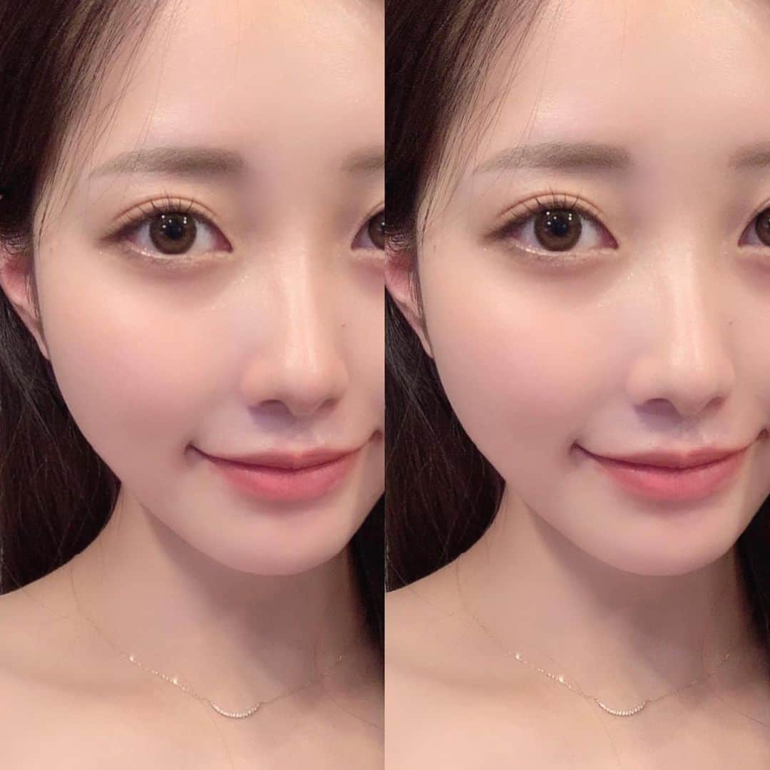 MIYUさんのインスタグラム写真 - (MIYUInstagram)「@kobe.clinic_fukuoka ♡ 今回もフォトシルク、イオン導入、コラーゲンピーリングをしていただきました。 あと肌の乾燥が気になったいたので、あわせてWIQOのクリームも購入しました！ 冬の肌、手入れがむずかしい時期けど頑張ろう🥲  #フォトシルク #コラーゲンピーリング #イオン導入 #kobeclinic福岡院」2月18日 13時50分 - miyu__.oo