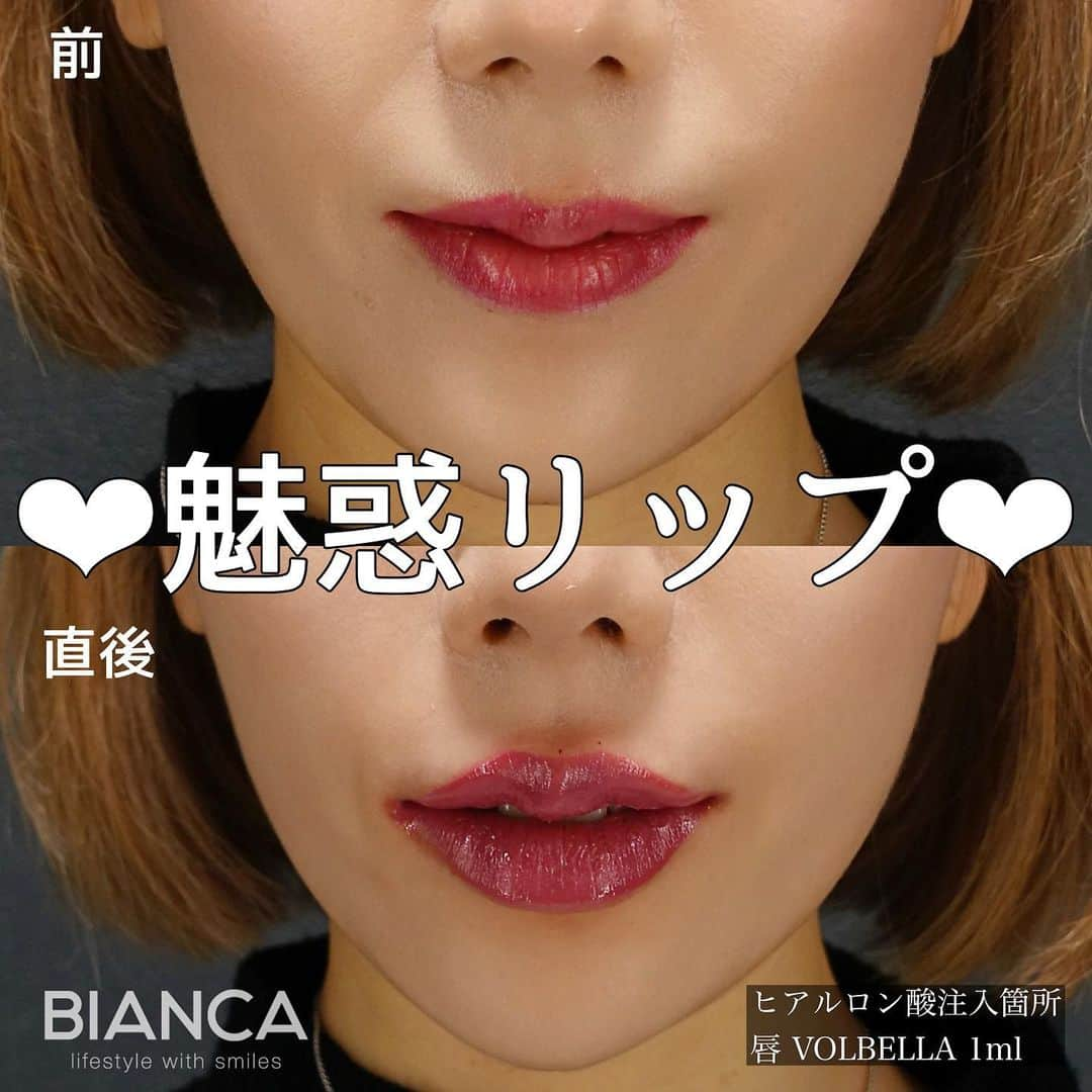 辻沢由有（BIANCA CLNIC 表参道院 院長）さんのインスタグラム写真 - (辻沢由有（BIANCA CLNIC 表参道院 院長）Instagram)「#dryuuヒアル ▶︎swipeで別角度&文字無し写真▶︎  ヒアルロン酸で速攻、更なる美人へ♡  美リップはお任せください😌 ヒアルロン酸はデザインが命です💉💓 お悩みを是非 お聞かせください✨  🌸唇ヒアルロン酸 💉 Juvederm VOLBELLA 1ml 　　77,000円 別途 ヒアルロン酸施術料 22,000円  ⏳治療時間: 10分 🗓持続期間: 1〜2年 😷腫れ・内出血: 数日程度 ⚠️リスク: 感染・血流障害・凹凸など  🉐モニター募集中💡💓 ⚠️ご予約の際は 『ゆう先生（辻沢）のインスタ見た』の一言をお願いします👩‍⚕️✨ 📍BIANCA CLINIC ✔︎表参道院 03-6433-5994 東京都港区南青山5-11-10  南青山511ビル 2F ✔︎銀座院 03-6263-2690  東京都中央区銀座1-5-6 銀座レンガ通り福神ビル 4F 診療時間 10:00〜19:00 年中無休（年末年始を除く）  #美容好き#プチ整形 #美容好きな人と繋がりたい#唇ヒアルロン酸#綺麗になりたい #美容皮膚科 #美容外科 #cosmeticsurgery #plasticsurgery #biancaclinic #ビアンカクリニック #リップマキシマイザー #followｍe #フォローミー #顎ヒアルロン酸#Eライン#モニター募集 #モニター募集中 #リップヒアルロン酸 #小顔整形  #鼻先ヒアルロン酸#鼻ヒアルロン酸#鼻整形#鼻尖形成」4月3日 19時15分 - i_am_yuu__