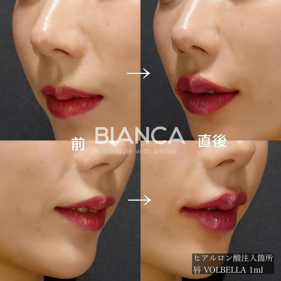 辻沢由有（BIANCA CLNIC 表参道院 院長）さんのインスタグラム写真 - (辻沢由有（BIANCA CLNIC 表参道院 院長）Instagram)「#dryuuヒアル ▶︎swipeで別角度&文字無し写真▶︎  ヒアルロン酸で速攻、更なる美人へ♡  美リップはお任せください😌 ヒアルロン酸はデザインが命です💉💓 お悩みを是非 お聞かせください✨  🌸唇ヒアルロン酸 💉 Juvederm VOLBELLA 1ml 　　77,000円 別途 ヒアルロン酸施術料 22,000円  ⏳治療時間: 10分 🗓持続期間: 1〜2年 😷腫れ・内出血: 数日程度 ⚠️リスク: 感染・血流障害・凹凸など  🉐モニター募集中💡💓 ⚠️ご予約の際は 『ゆう先生（辻沢）のインスタ見た』の一言をお願いします👩‍⚕️✨ 📍BIANCA CLINIC ✔︎表参道院 03-6433-5994 東京都港区南青山5-11-10  南青山511ビル 2F ✔︎銀座院 03-6263-2690  東京都中央区銀座1-5-6 銀座レンガ通り福神ビル 4F 診療時間 10:00〜19:00 年中無休（年末年始を除く）  #美容好き#プチ整形 #美容好きな人と繋がりたい#唇ヒアルロン酸#綺麗になりたい #美容皮膚科 #美容外科 #cosmeticsurgery #plasticsurgery #biancaclinic #ビアンカクリニック #リップマキシマイザー #followｍe #フォローミー #顎ヒアルロン酸#Eライン#モニター募集 #モニター募集中 #リップヒアルロン酸 #小顔整形  #鼻先ヒアルロン酸#鼻ヒアルロン酸#鼻整形#鼻尖形成」4月3日 19時15分 - i_am_yuu__