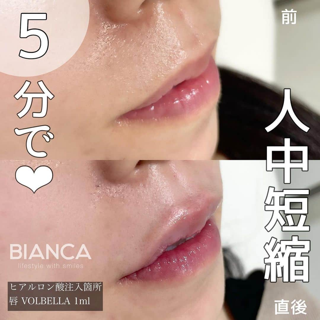 辻沢由有（BIANCA CLNIC 表参道院 院長）さんのインスタグラム写真 - (辻沢由有（BIANCA CLNIC 表参道院 院長）Instagram)「#dryuuヒアル ▶︎swipeで文字無し写真▶︎  ヒアルロン酸で速攻、人中短縮❤️  美リップはお任せください😌 ヒアルロン酸はデザインが命です💉💓 お悩みを是非 お聞かせください✨  🌸唇ヒアルロン酸 💉 Juvederm VOLBELLA 1ml 　　77,000円 別途 ヒアルロン酸施術料 22,000円  ⏳治療時間: 10分 🗓持続期間: 1〜2年 😷腫れ・内出血: 数日程度 ⚠️リスク: 感染・血流障害・凹凸など  🉐モニター募集中💡💓 ⚠️ご予約の際は 『ゆう先生のインスタ見た』の一言をお願いします👩‍⚕️✨ 📍BIANCA CLINIC ✔︎表参道院 03-6433-5994 東京都港区南青山5-11-10  南青山511ビル 2F ✔︎銀座院 03-6263-2690  東京都中央区銀座1-5-6 銀座レンガ通り福神ビル 4F 診療時間 10:00〜19:00 年中無休（年末年始を除く）  #美容好き#プチ整形 #美容好きな人と繋がりたい#唇ヒアルロン酸#綺麗になりたい #美容皮膚科 #美容外科 #cosmeticsurgery #plasticsurgery #biancaclinic #ビアンカクリニック #リップマキシマイザー #followｍe #フォローミー #顎ヒアルロン酸#Eライン#モニター募集 #モニター募集中 #リップヒアルロン酸 #小顔整形  #鼻先ヒアルロン酸#鼻ヒアルロン酸#人中短縮 #人中短縮ボトックス #人中短縮ヒアル」4月4日 11時17分 - i_am_yuu__