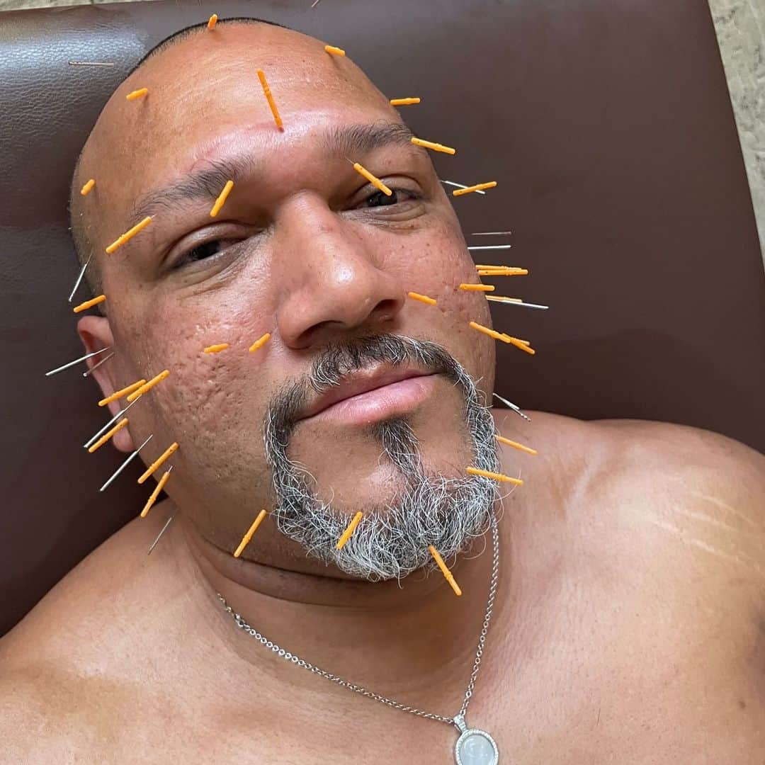 アレックス・ラミレスさんのインスタグラム写真 - (アレックス・ラミレスInstagram)「March is the worse month of the year for me because of #花粉症 so bad that’s why I have to do acupuncture on my face, it really helps me! #acupuncture #face #feelsbetter #3days #backtonormal #ramichan #vamos」3月18日 9時26分 - ramichan3