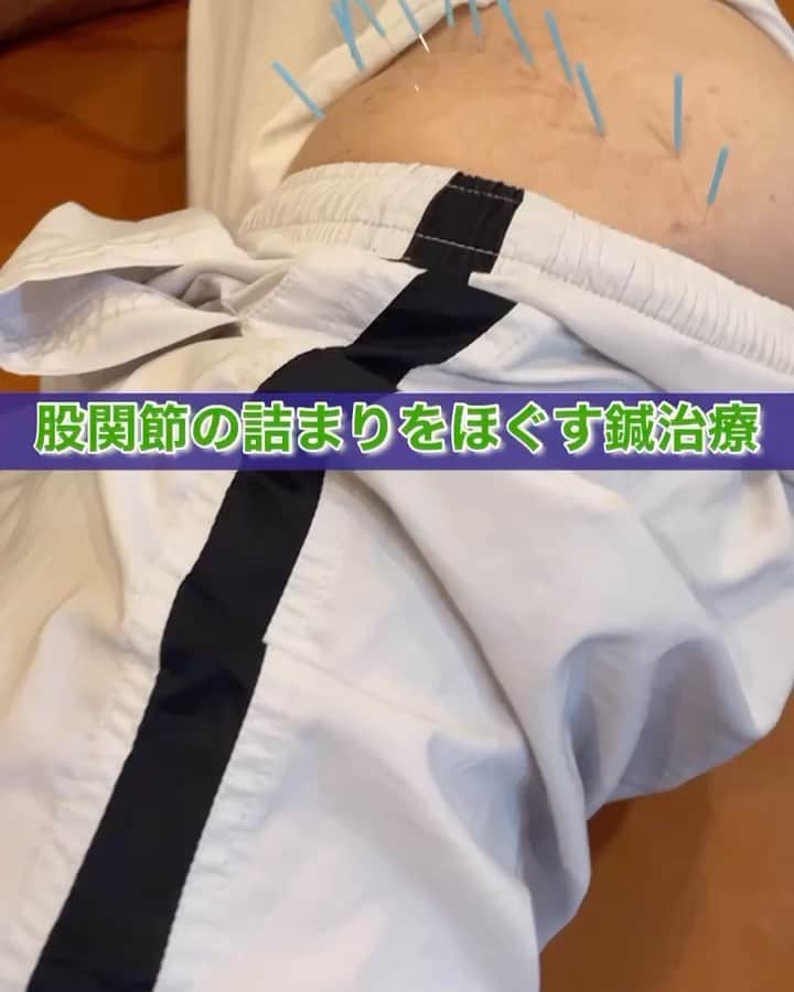 nobuaki.aokiのインスタグラム：「股関節に詰まり感のある方への鍼治療です。刺鍼後ゆらゆら動かすことでよりしっかり刺激を入れています。患者さんは「気持ちいい」と仰ってました^_^ ご参考まで#股関節治療#鍼治療#股関節ほぐし#青木治療院然」