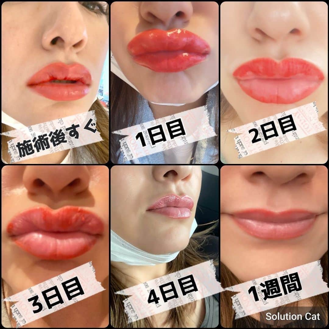 仁科仁美のインスタグラム：「リップアートメイクのリアル報告♡  まず…絶対オススメ！！！ 【ただ…私はすごーーーーーーく痛くて…何種類も塗る麻酔をしてもらいました（ ; ; ）】  @medicalbrows_hikichi さん、本当に本当にありがとうございました♡  私は眉毛アートに引き続き、@medicalbrowsにてお願いしました♬  施術後すぐの感想は…私の脳内【えっ、真っ赤なんですが…このままだったらどうしよう…。。。】でした。 が、しかし…2日目ーーーーー！ 朝鏡を見て…私の言葉【えぇーーーーーリアルたらこやんーーーーーー！！！終わった。。。】  でも…２日目も腫れはあるものの…脱皮が始まり、月日は流れ…もう４日目位からマスクなしでも、リアルたらこは消え去り♬  １週間後の写真がスッピンの何も無の状態のリップです！！♡  まぁー色が綺麗で、程よい赤みで…透明のリップだけでもう、十分の十分♡  痛みを耐えた者にのみ、得られる楽さ♡笑  最高です♬  マスク中の今から、リアルたらこも怖くない！！おススメです♡  #Medicalbrows #メディカルブロー #メディカルブロー銀座院 #アートメイク東京 #アートメイク #メディカルアートメイク #リップアートメイク  そして、なんと…クーポン発行してくださいました♬  下記↓詳細です⁎ˇ◡ˇ♬ この機会に是非♡  1ヶ月以内にこの投稿を見て予約をするとロイヤルアーティスト以上のアートメイク2回コースが10%OFF 予約時に必ず割引番号「3311」をお伝えください。 月曜日～木曜日の平日、表参道メディカルクリニックのみ対象となります。」