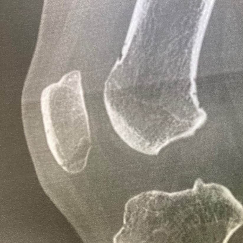 高山俊さんのインスタグラム写真 - (高山俊Instagram)「6月29日の試合中に右膝に自打球を受け、右膝蓋骨骨折(膝のお皿の骨折)という診断を受けました。 一日でも早く復帰する事が今の僕の目標です。」7月3日 11時42分 - shun_takayama09