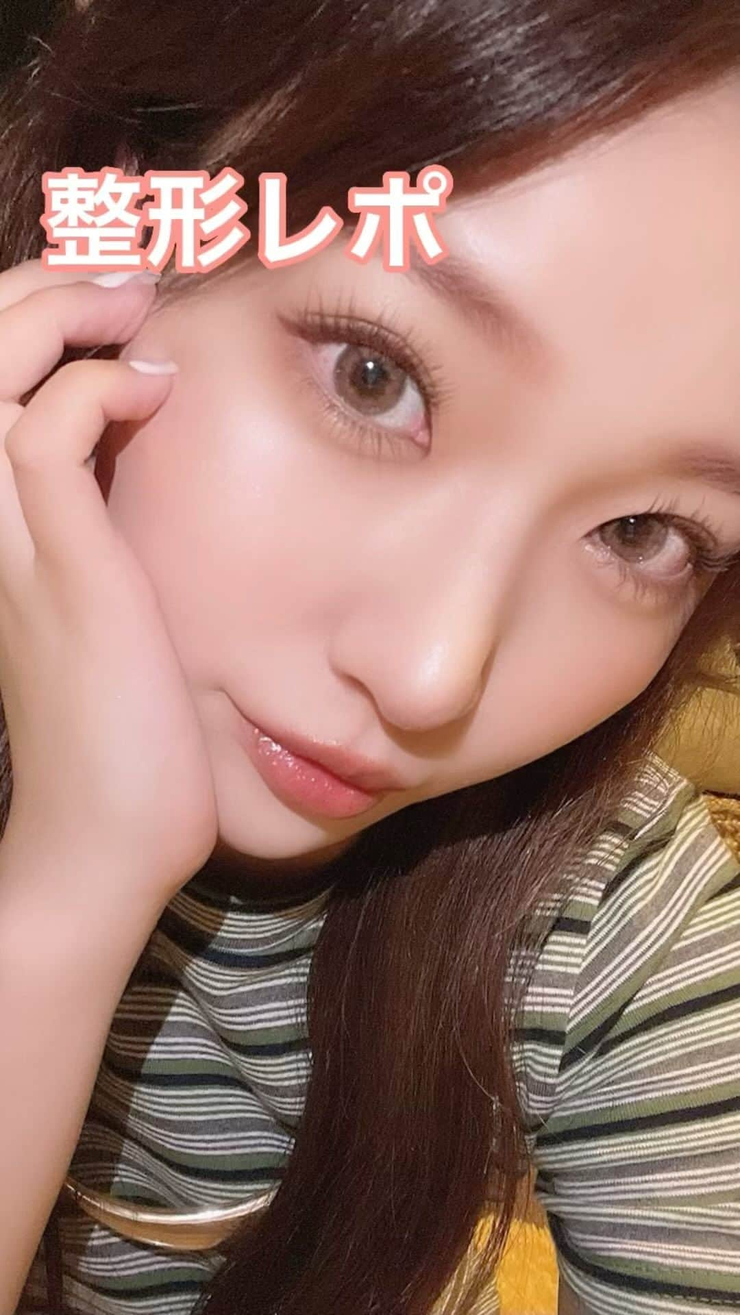 いっちゃん/嶋津 いつみのインスタグラム：「お待たせしました🙇⋱ 整形レポまとめ第1弾は鼻編です👃✨ . 今回、私がやった手術は耳から軟骨を採取して それを鼻に入れて高さを出すのと、 鼻先の形を整える。というものです☝🏻 . THE整形しました‼︎って鼻よりも 私の顔に馴染む、似合うお鼻にして下さい。と先生にお話していたので 今回は尾翼縮小術はしていません🙅🏼‍♀️ . . 手術自体は静脈麻酔で眠ってる間に終わるので 体感としては瞬きしている間に終わりますw . . 目が覚めると、耳が痛かったです😭💦 状態としては、鼻にギプスがしてあって鼻の下にガーゼがあててあるのと 鼻の中にもガーゼが入ってるので鼻呼吸できません🙅🏼‍♀️ あと耳の👂窪み？(イヤホン入れると埋まっちゃう部分)にも ギプスが入ってるので片耳は聞こえません💦 . . 痛みは我慢できない程の痛みではないので しっかり目が覚めてから、自分で着替えてタクシーに乗りました🥸 . . 当日は自宅が近ければ帰宅出来ますが、遠い方は 念の為近くにホテルをとることをおすすめします。と 先生が言ってました😃 . . 鼻自体の痛みはほとんどありませんが、 耳は痛いです💦 . 軟骨にピアスを開けたことがある人は分かるかと思いますが、あの時の痛みが耳全体にある感じです😢 . . 痛み止めが切れるとすごく痛いので 当日から2日目までは痛み止めが切れないように飲み続けてました。 . 痛み止めが効いている間は我慢できる程度の痛みなので いつも通りに家事もこなせましたし コンビニぐらいまでなら翌日から歩いていけました💓 . . ただ、耳を下にして寝れないのと… 当日の夜は鼻腔にガーゼが入れてあるせいで 鼻呼吸はできないし、その上ギプスで固定されてるのでなかなか眠れませんでした🙄 . . 腫れは2日目あたりがピークに腫れました！ 鼻はギプスをしてるので分かりませんでしたが 顔全体が膨張して目も開けにくい、涙袋は消える、二重はなくなる…って感じでしたし 耳の後ろを切っているので、その影響で耳下腺のあたりやリンパが腫れて おたふく風邪みたいな腫れ方をしてました😂 . . 本来なら5日目にギプスをとるのですが、 私は2日目の夜から急に顔、首に発赤を伴うブツブツかできて 猛烈に痒かったので、急遽先生に連絡し 翌日の診察にて3日目ですが ギプスを外すことになりました😭💦 . 結局、ブツブツは手術に浸かった消毒液によるかぶれだったので 塗り薬をもらいました💦 . 3日目から徐々に整形の腫れはひいていく感じでしたが かぶれによる腫れもあったので 本当に腫れがひいてるのかよく分からなかったです😂w . . 4日目からはかぶれが少しマシになって 耳の痛みも随分とマシになってきて一回も痛み止めを飲まずに過ごせるようになりました☝🏻 . 5日目6日目は 徐々に腫れも痛みもマシになってはきましたが 特に大きな変化はありませんでした。 . . ギプスを外した時に この分だと早めに抜糸が出来そう！と先生が言ってくれたので 本来は10日目に抜糸するんですが 7日目に抜糸してもらいました❤️ . 抜糸出来るかのポイントは 感染徴候があるかないか、その後の傷のケアがちゃんと出来そうか… らしいんですが、私は看護師ということもあり 感染対策、創部管理ができるので早めの抜糸となりました🤗 . . 抜糸後は急激に腫れも引いていきました😆🌈 . . ちなみに鼻の中の糸は溶ける糸で縫ってあるので そのまま放ったらかしで大丈夫なんですが ずっーと鼻クソ(下品でゴメンなさいw)がへばりついてるような感じがして 地味に不快でした🫥💦 . あとは耳のギプスも、片耳が聞こえなくなるので 割と不快でした😵‍💫 . . 2週間目以降は耳下腺の腫れも目立たなくなり 普通にメイクして普通に出かけられました🤗💓 . . お鼻の整形の腫れや浮腫みが完全になくなって 安定するには6ヶ月かかるそうですが １ヶ月半がたった今、だいぶ顔に馴染んできましたし 自分の鼻が気に入ってます🫶🏻 . . ちなみにお値段は…約80万円です😵‍💫💦 （診察料、カウンセリング料、薬代は別途かかります。） . 決して安いわけじゃないです💦 でも、それでも… ずっとずっとコンプレックスだった鼻が綺麗になって 「なんでもっと早くやらんかったん？」って 自分で思うほどやってよかった‼︎と思ってます🥰💓 . 新しい自分に生まれ変わった気分です‼︎ . . お値段は私の場合は…というだけであって皆さんがこのお値段で出来るわけではないので お気をつけ下さいませ🙇‍♂️ . . どんな整形でもそうですが どんな鼻になりたいか、じゃあ自分の今の鼻から 理想の鼻になるためには どこをどうしないといけないのか…が人それぞれなので それによってお値段も変わってくると思ってください🙇‍♀️ . . なので私のはあくまでご参考程度に😌🙏🏻 . . そして、決して整形を斡旋するわけではく これはあくまでも私の個人の経験と感想をレポしたものですので その点ご理解いただけますようお願いいたします☺️ . . #整形 #整形レポ #美容整形 #美容整形レビュー」