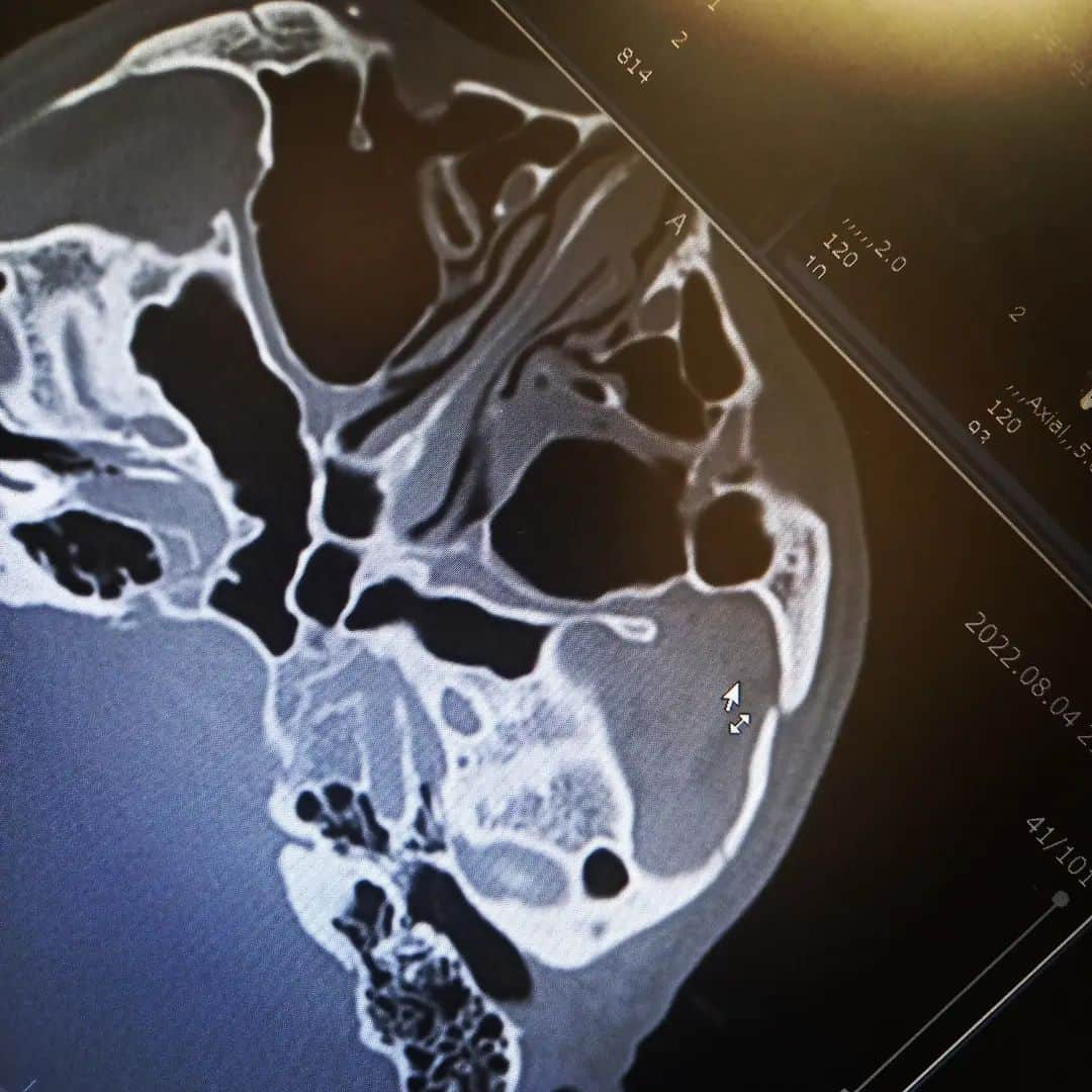 瓜田純士さんのインスタグラム写真 - (瓜田純士Instagram)「この度、旦那の瓜田純士が救急診療で内科の先生に診て貰った所 眼窩底を数箇所と上顎と頬骨も数箇所 骨折しました (練習中の怪我です)  吐き気も頭痛も酷く下顎も折れてる形跡もあるらしく明日朝イチでもっと脳やら色々再度詳しく見て貰って来ます  手術が済み、落ち着く迄のお仕事は全キャンセルになります  ご迷惑お掛け致します  瓜田夫婦  #瓜田純士 ⁡ ⁡#顔面⁡ ⁡#骨折⁡ ⁡#容態 #悪化」8月4日 23時11分 - junshi.reiko