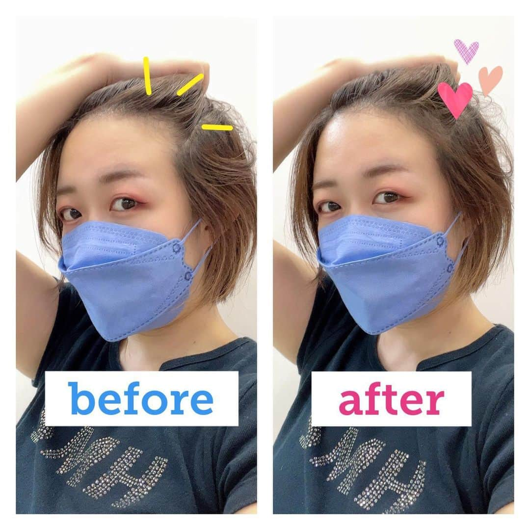 蛯原天のインスタグラム：「お世話になってるスーパーミリオンヘアーの新商品、生え際の最強小顔アイテム「SMHヘアファンデーション」のビフォアフ載せる！ 私のイカつい剃り込みがカバーされて丸い額に🥹 美容成分いっぱいなんで髪がパサつかないのも嬉しい！ 白髪の簡単なレタッチにもなるので白髪の方にもおススメです！ 　　 　　 　　 　　 　　 　　 #smhヘアファンデーション #スーパーミリオンヘアー #madeinjapan #souvenirofjapan #ヘアケア #ヘアメイク #白髪 #アンチエイジング #便利グッズ #cosmetics #hairstyle #hairmake #小顔 #小顔メイク #ドラッグストアショー #コスメ #美容」