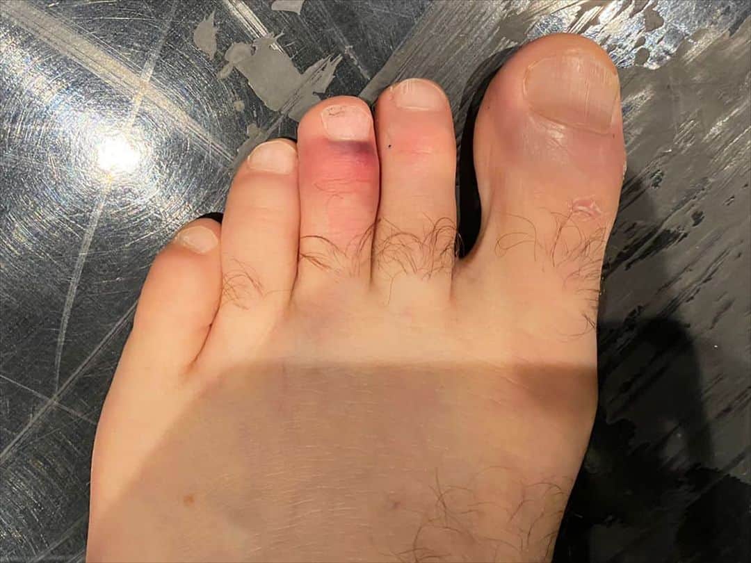 アラン・カミングのインスタグラム：「Trigger warning! If you are not in the foot fetish niche of bruised toes, please close your eyes! But I just wanted to tell you that I feel very much a real dancer now as I did the last ever performance of Burn at the Joyce in NYC with a broken toe which was strapped up and I was filled with ibruprofen and battled through. Showbiz!!」