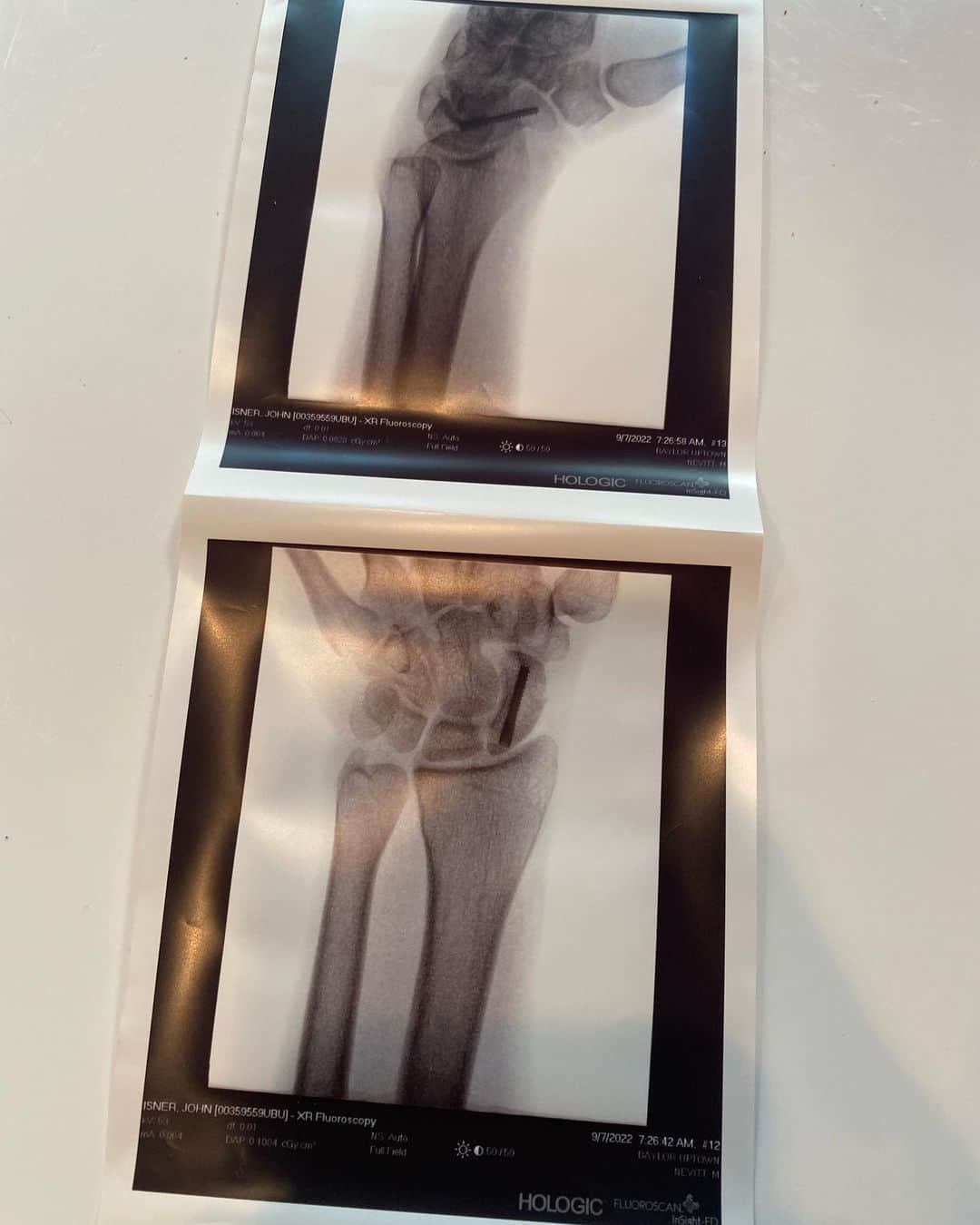 ジョン・イスナーのインスタグラム：「Didn’t have the best fortunes in New York and broke my wrist in my 1st rd @USOPEN win. I now have some new hardware that will be with me forever.   It’s going to take a team to get me back out on the court in 2023 and I’m very appreciative of the care I’ve received from my team of medical experts. If you’re putting together a winning team, @ZipRecruiter helps you find the right people to make your business successful. Try it for free at ZipRecruiter.com/JohnIsner #ZipRecruiterPartner #ZipRecruiterUnsungHeroes」