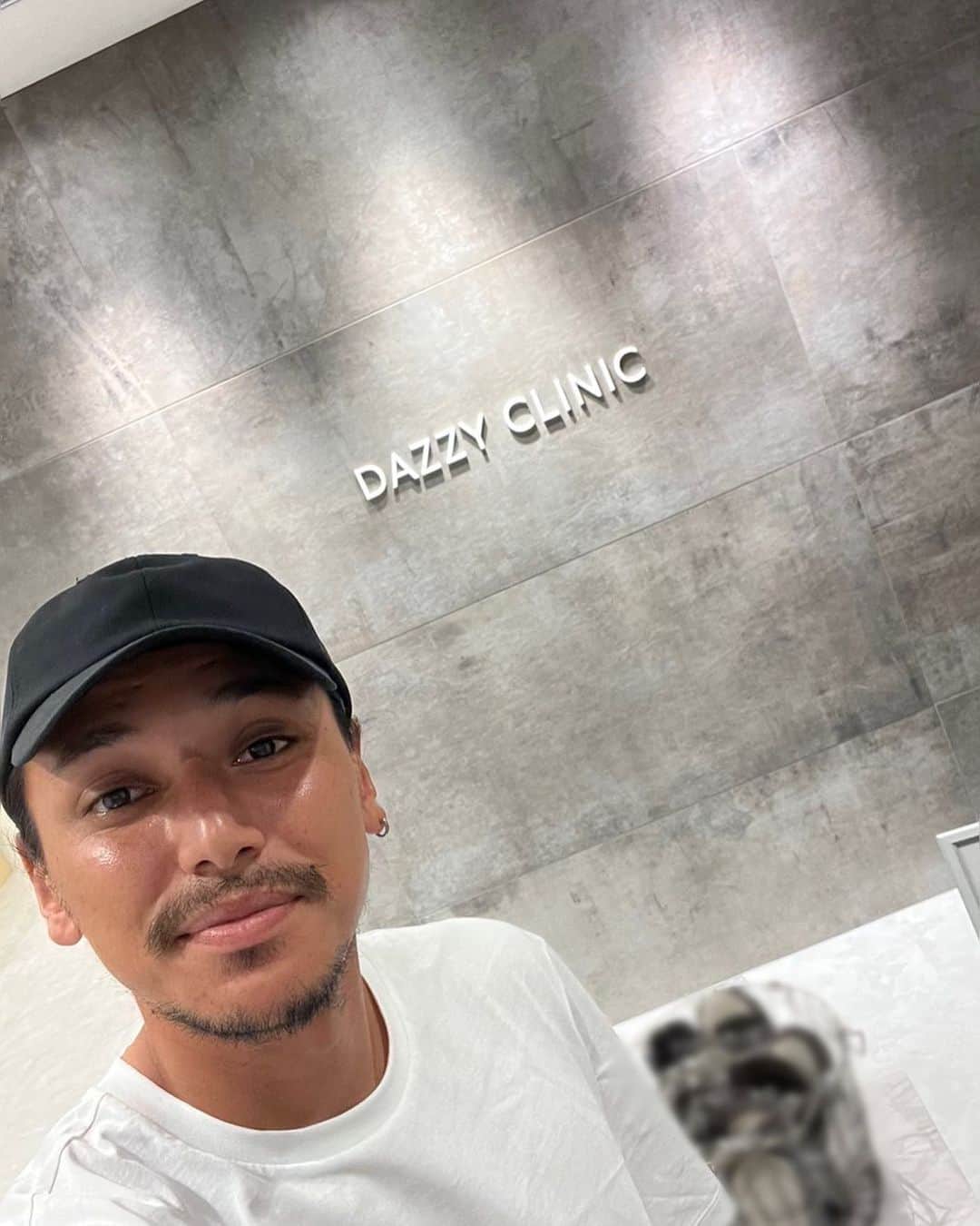 大崎玲央のインスタグラム：「@dazzyclinic_shinsaibashi  で医療脱毛して頂きました！ スタッフさんもとても丁寧で、 痛みもそれぼどなく短時間で終わりました。メンズも是非！」