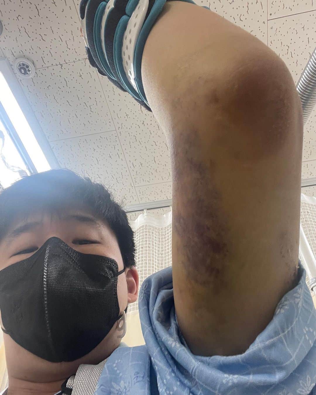 テハのインスタグラム：「차조심... 나만 조심하면 크게 안다칠줄 알았는데 그건 또 아니네.. 바이크 접음」