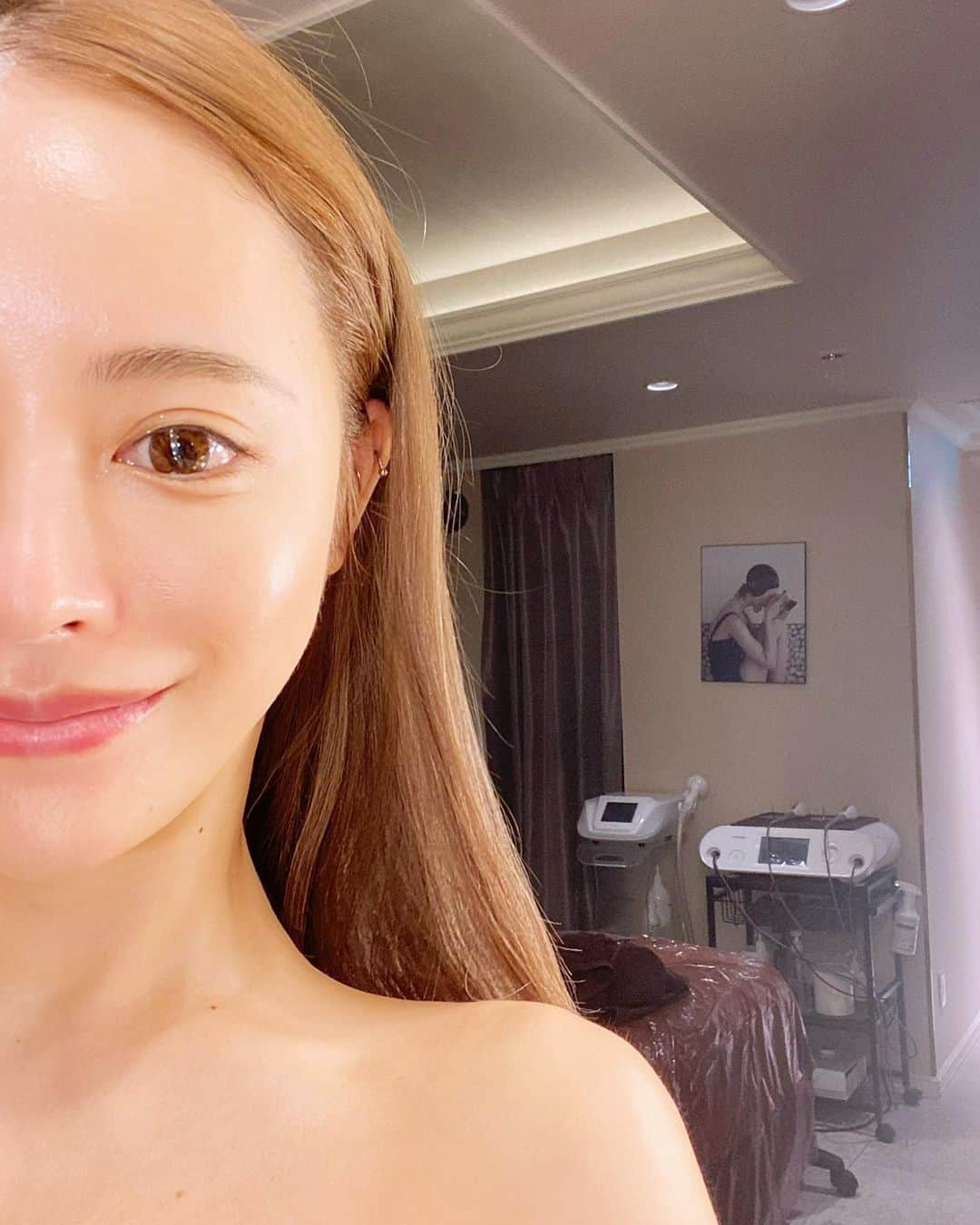ririのインスタグラム：「最近やった美容で 気に入ったのが @wiclinic.ginza の ボトックスリフト‼️⭐️  効果でるか見たかったから 1ヶ月くらいたつんだけど 頬下のもたついた皮膚たちが キュッ"としまってかなりシャープな 輪郭になりました💕💕 首とフェイスラインに 打つんだけど💉口角をさげる筋肉に アプローチするから上にキュッ"と あがるらしいです🤔🧡  サーマジェンもお肌を 引き締めてくれるから 定期的にやっていて、 ハイフとはまた違うんだけど お肌がしまる感じが すごい好きで続けてます✨✨  @dr_katsuki 先生美人だし めちゃ的確なアドバイスくれるので カウンセリングおすすめですよ💕  ボトックスリフトは けっこうかわったから やる価値ありそうだよ💋💕  またなんかいい病院情報🏥あったら シェアするね😘✌️  あと、お肌ピカピカになる 美容液はストーリーのせたから チェックしてみてね💙  #love #happy #smile #美容 #ボトックス #サーマジェン」
