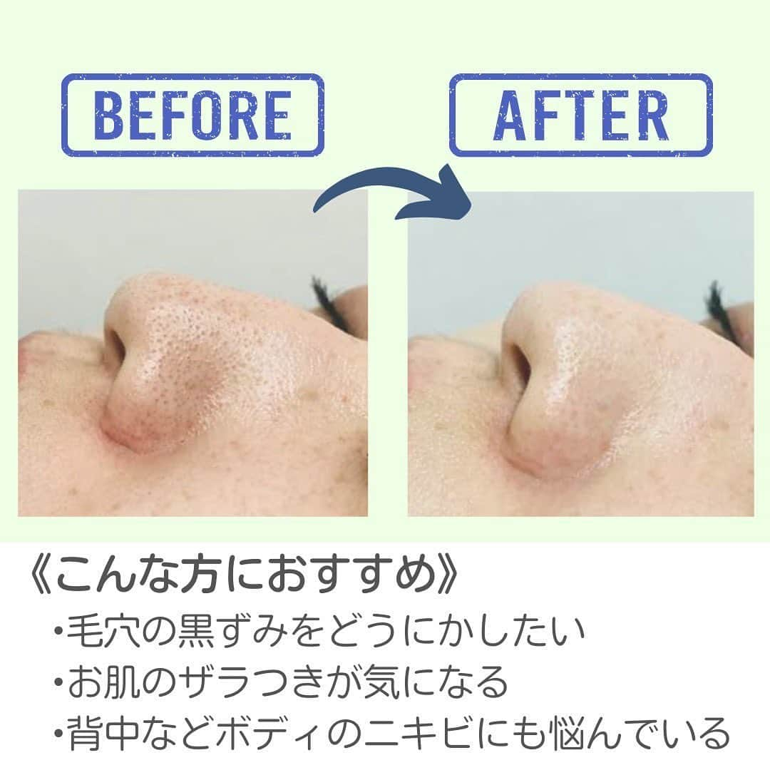 NATURAL HARMONY CLINICさんのインスタグラム写真 - (NATURAL HARMONY CLINICInstagram)「毛穴が気になる方へ おすすめ施術のご案内です☺️  ①ケミカルピーリング ②ビタミンCイオン導入 ③ハイドラジェントル�  その日からメイクも◎ ダウンタイムも無し✨ 3つの組み合わせがおすすめです🎃 …………………………………………………………  〒150-0001  東京都渋谷区神宮前６丁目２５−１４ 神宮前メディアスクエアビル 5F 📞0800-800-4977 🏥10：00〜19：00（日曜休診）  ………………………………………………………… #毛穴ケア #毛穴の黒ずみ #毛穴の開き #毛穴改善 #ニキビ #ピーリング #イオン導入 #ビタミンC #ハイドラジェントル #肌荒れ #美容医療  #美容クリニック #美容大好き #美容好き  #美容好きと繋がりたい #beauty #ナチュラルハーモニークリニック表参道」10月24日 17時35分 - natural_harmony_clinic