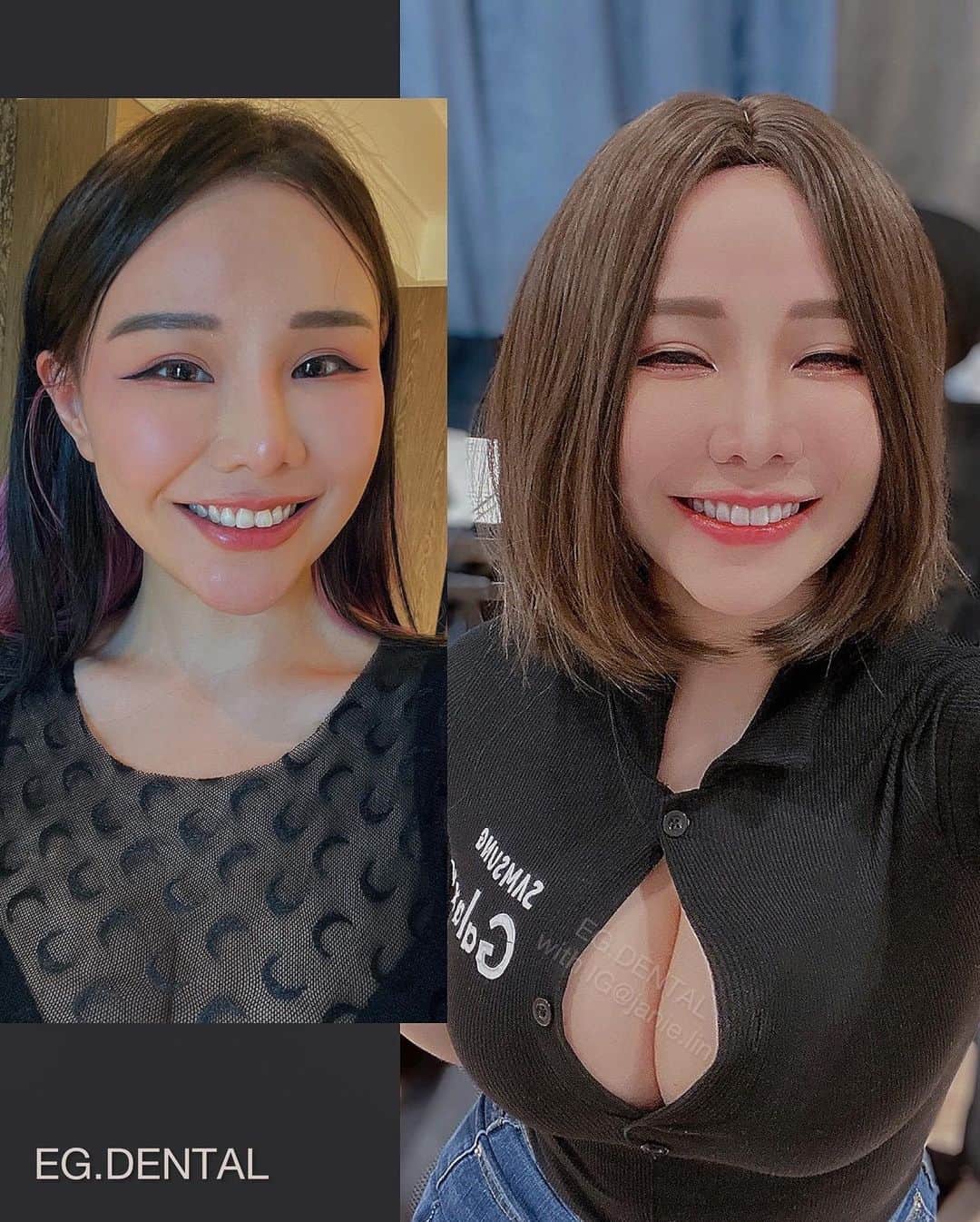 泥泥林のインスタグラム：「𝙸 𝚕𝚘𝚟𝚎 𝚖𝚢 𝚜𝚖𝚒𝚕𝚒𝚗𝚐 𝚏𝚊𝚌𝚎 𝚜𝚘 𝚖𝚞𝚌𝚑♡ #陶瓷貼片 #做完一年了 #我的牙醫  我的貼片一歲了！笑起來是不是很好看🙈  雖然小時候很常被稱讚牙齒很整齊很漂亮 但自從越來越多拍片跟拍照的需求之後 就開始漸漸發現牙齒真的是門面！！  有看我YT影片的同學應該都知道 我就是表情很多又超愛大笑的傢伙 所以除了天生門牙有點內旋以外 以及吃貨如我，咬到筷子門牙斷了一角（圖二） 再外加大笑會露出太多牙齦肉 這些都一直讓我覺得沒有很好看🤣🤣🤣  去年終於下定決心去做了陶瓷貼片！ 做了很多功課之後，最後決定在 敦南上境 做 除了醫生的審美觀跟我很合以外 操作的技術跟術式中的舒適度也都很值得讚許ჱ̒  ｰ̀֊ｰ́ )  前前後後拍了很多照片 醫生會依照我們的臉型、嘴唇等等 去設計最適合你的完美微笑弧度  我這次做了牙冠增長跟陶瓷貼片！ 現在已經做滿一年的時間了～ 除了笑起來太好看以外，沒有其他問題✨（喂  Ps.  去做貼片的詳細過程有拍Vlog 想了解我選用的材質跟更多細節的同學 可以去我YT「泥泥學姐」搜尋敦南上境看看🤍 ------------------------------------------------- 【敦南上境】牙齒美白｜陶瓷貼片｜隱適美｜植牙 🔹電話 : 02-2700-0123 🔹預約 : @egdental  #敦南上境  #美齒貼片 #台北牙醫」