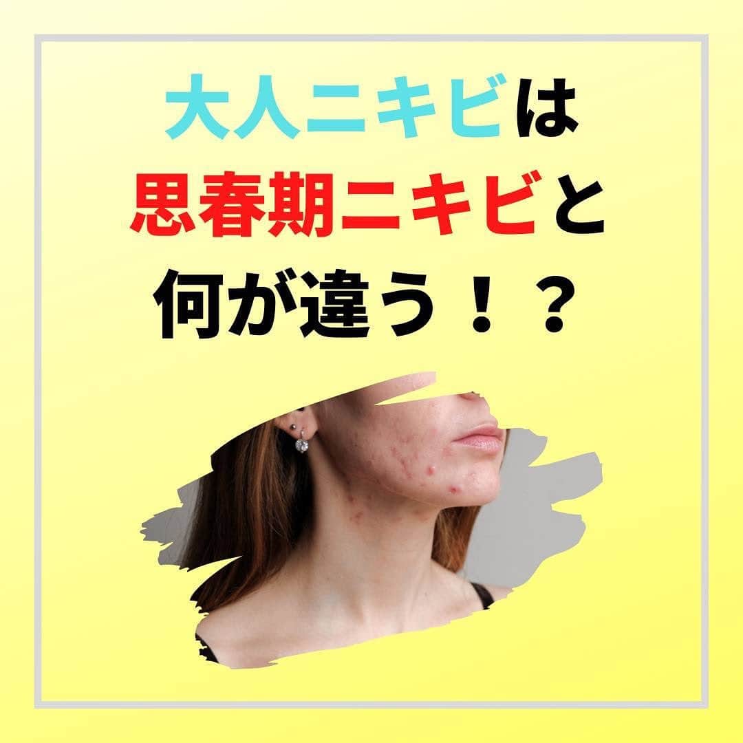 NATURAL HARMONY CLINICのインスタグラム：「* * 思春期を過ぎ大人になってもニキビに悩んでいる方が多いと思います🥺 同じ場所にくり返しできることが多く、ニキビ跡も残りやすい大人ニキビに悩まされている人も多いのではないでしょうか。そんな「大人ニキビ」に対処するためには、大人ニキビの特徴や原因を知り、適切なスキンケアや対処法を知ることが大切です🤭 * * #すっぴん美人 #すっぴん美肌 #スキンケア順番 #スキンケアルーティン #素肌美人になりたい #すっぴん女子 #すっぴん肌 #毛穴レスになりたい #毛穴レス肌 #ニキビ予防 #ニキビ治したい #ニキビスキンケア #ニキビ薬 #ニキビ化粧水 #ニキビ悩み #ニキビに効く #ニキビケア用品 #ニキビ皮膚科」