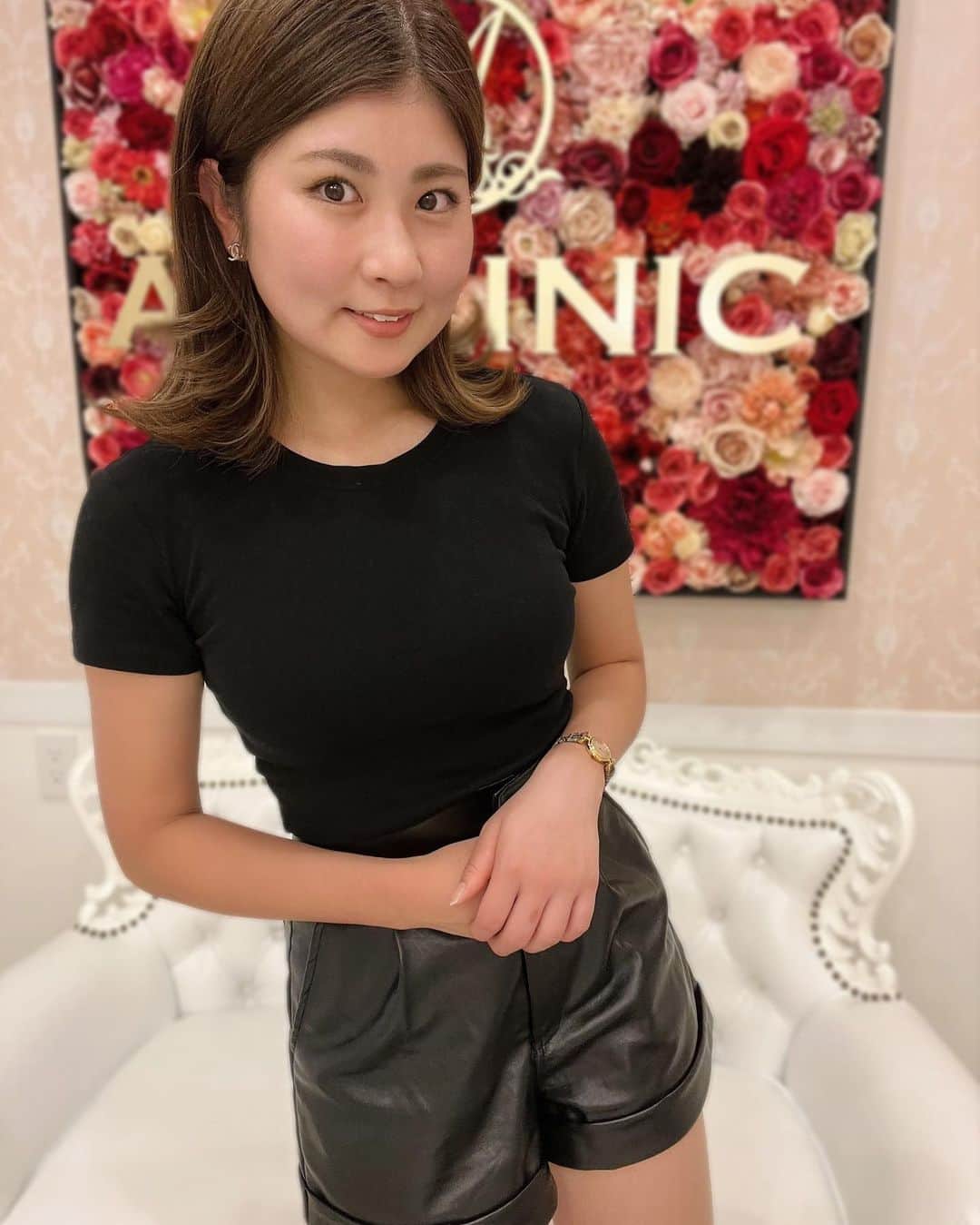 のインスタグラム：「*＊ フェイスライン引き締め✨ @aclinic_shinjuku でAスレッドをやってきました！ 担当してくれたのは @aclinic_toda 戸田先生🧑‍⚕️ とっても丁寧で、落ち着いて受けることができました🌿 丸顔が悩みだったけど、ほんの数分で解決できたのがびっくり！！🤣  2枚目のビフォーアフターすごいでしょ。 どっちもiPhone純正カメラです🫤 afterが真顔(笑)  輪郭がシュッとなって気分も上がってます❤️ また1day小顔脂肪吸引とかもやってみたいなぁ。 . #aスレッド #糸リフト #aclinic #aclinic銀座 #aclinic横浜 #aclinic新宿 #aclinic名古屋 #aclinic大阪 #aclinic福岡 #aclinic池袋 #aクリニック #エークリニック#小顔 #リフトアップ #スレッドリフト #小顔整形 #たるみ改善 #美容外科 #美容皮膚科 #美容クリニック #戸田貴之」