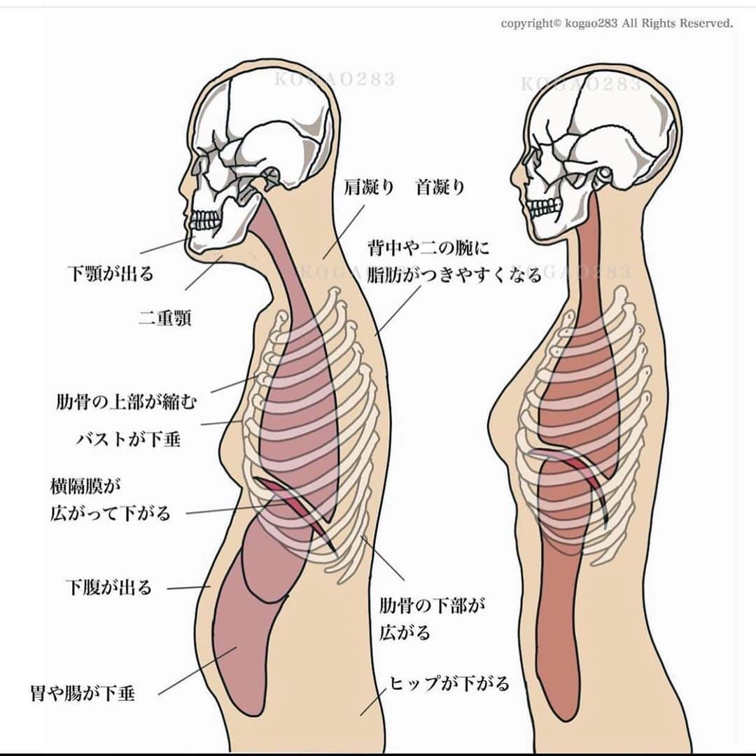 kogao283さんのインスタグラム写真 - (kogao283Instagram)「貴方の姿勢は大丈夫ですか？  「猫背姿勢でいると横隔膜がしっかりと使えない」  猫背姿勢で長時間デスクワークをしていると胸部・腹部が圧迫される為　大きく空気を吸い込む事が出来なくなります。  すると　本来呼吸をする度に動いていたはずの「肋骨」をあまり動かさなくなります。 その状態で浅い呼吸をするので筋肉（肋間筋）はどんどん硬くなります。  すると　デスクワークから開放されても猫背の姿勢が保持された状態になってしまいます。 これが「慢性的な猫背」になります。  猫背を予防するには ・「大きな呼吸をする事によって横隔膜を使い　 肋骨を動かす（＝肋間筋の伸張・収縮）事により　 筋肉を硬くさせない」事が大事です。   重力は骨や筋肉を強化してくれ、 “立つ”“歩く”といった基本的動作を 行うためにも欠かせないものですが 2足歩行になった私たちの肌や筋肉は、 年齢の変化により 重力によって垂れていきやすくなります  そして、二足歩行になったことで脳が大きくなり、 背骨にも重力がかかるようになったため、 猫背にもなりやすく😣  すると、姿勢が前かがみになるのでバストが垂れ、 おしりが下がりやすくなってします  また姿勢の悪さで血液循環など 循環器系にも支障が出るためお顔も浮腫みやすくなります」12月6日 19時53分 - kogao283