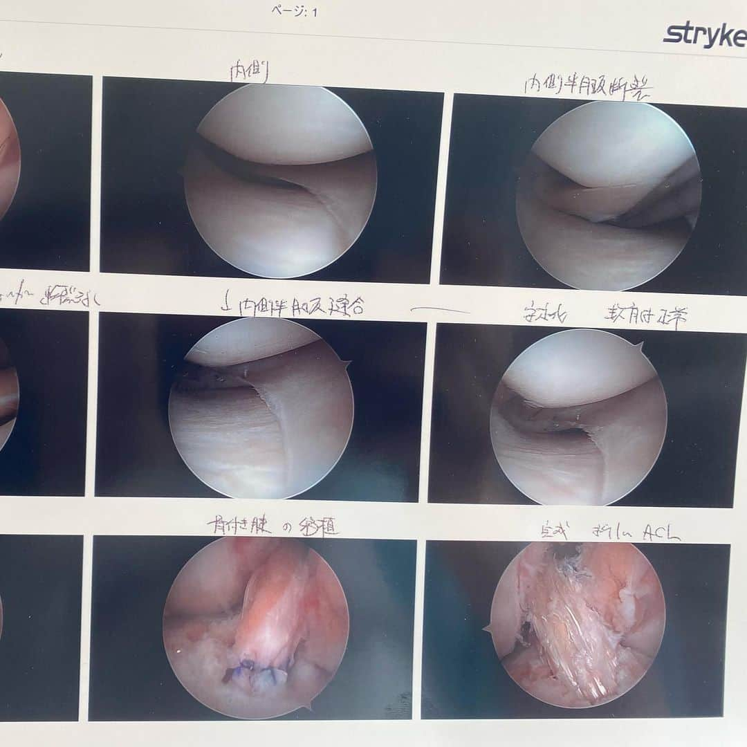 萩原亜咲さんのインスタグラム写真 - (萩原亜咲Instagram)「✴︎前十字靭帯損傷からの手術のお話✴︎ いつか誰かの役に立つことを願っての記録。  8/24 いつも通りクライミングしてたんだけど、少し寝不足で集中力もなく今考えると色々良くなかった！ 終了点直下で両手がすっぽ抜け着地姿勢を取れないまま地面まで落下。(人生初) 右膝を完全に折りたたんだ正座の状態で落ちすぐに感じたことのない痛みが走りこれは一瞬で結構なケガをしたと思った。 すぐに病院に行ったんだけどまさかの膝専門がいなくて診断もつかぬまま帰されるという。 このあと病院探しに時間もかかるわなんかイマイチすぎて説明は省く(笑) 結果、前十字靭帯損傷だったんだけどね。  なんとなーく調子も戻ってきてこのまま騙し騙しいけるかなと思った10月末、全然たいしたことのない高さで壁から右脚で降りた時角度が悪かったらしく膝崩れする。 聞いたことのない音がカラダから聞こえた。 あの感覚が恐怖でもうこれは無理！となった… 腫れもあったし、もしかしたら部分断裂からの完全断裂したのかもしれない。 やっちまったー  それからお客さん頼みで情報をもらい病院と先生を決め手術をお願いしに行くことに。 幼い頃から周りはモーグラーやスキーヤーでの前十字靭帯再腱術はよく聞いていたけど、2〜3週間の入院や固定…幼い子ども二人もいるのにかなり現実的ではないなーと思っていた。 スポーツ外来を受診してMRIを撮り先生と話しを進めていくとめちゃくちゃアスリート手術してるし、術式もリハの進め方も驚く内容だった。  まず、前十字靭帯の再建手術には2種類。 ①ハムストから腱を取り移植 ②膝蓋腱を部分的に骨ごと移植 多くは①で手術をするのがほとんどだとか。  今回私が受けた手術は②だ。 ①の手術で結局緩みが出てしまったり再断裂したりした人がわざわざ先生のところに②を受けに来るそう。 更には②の術式でもケガした脚ではなく元気な脚の膝蓋腱を取るという。驚き〜！ 先生曰くその方が術後の回復が圧倒的に早くリハも順調に行くとか。 (確かにリハビリを進めていくと納得できるポイントたくさんあって元気な脚から取ってよかった) 靭帯の強度も1年過ぎると元の靭帯より強くなるらしく、色々聞いて最強かよ！ってなった。 極めつけはリハビリ方針。 『だいたい一週間で歩行して退院かな。一ヶ月は歩行と荷重時のみ装具着用で。』 へぇぇええええ〜！？ 想像はるかに超えていて最初の受診日に手術日決めてきた。  この術式こそのスピードで再断裂率も2%以外と。どうしても術後1.2ヶ月移植した腱が最弱になるのと、4ヶ月程度で元通り動け過ぎて調子こいての再断裂が多いそう。 気をつけよう！これから雪道だし。 ちなみに内側半月板も損傷していて、(これはもしかしたら今回のケガじゃなく蓄積かな？とのこと)ついでに縫合してもらいました。それでも荷重かけたりのリハビリ変わらないの驚き。  そしてこう書き記すうちに術後4日目で単独歩行、6日目で退院となりました。一週間経った今日は本当にスタスタ歩ける。 さすがに長時間立ってると痛ダルくなってくるけど。  さぁこの冬は更なる下半身強化に向けてリハビリ頑張るぞー！ クライミングはまだしばらくできないけどもう2回の妊娠出産で離れることの恐怖は無くなったし、コツコツやれる事続けていれば自分の中でまだ技術に磨きがかかっていく感覚がある。 楽しいよなーそこがまた。  もちろん一度壊したから元通りにはならないのはわかっているけど、これでこれから元気に遊び回るであろう子どもたちともしっかり不安なく向き合えるようになると思うと安心かな。 プロのアスリートも大好きな趣味でやってる人も大きなケガと向き合ってまた続けている人がたくさん。 たまたま私が20年以上ケガしなかったのはただの奇跡かもしれないし、攻めきれてないだけかもしれない(笑) 一週間の入院を経て、日々の忙しいながらも過ごす生活がなんて充実して幸せなんだと感じれた事はこの先の人生の充実度をさらに上げてくれるに違いない…w そしてお約束の用にワンオペ時体調崩す我が子たちには笑うけど、行っといで〜と送り込んでくれてさんきゅう。  食いしん坊な姉妹はアレ食べたいコレ食べたいの意思表示から成長していく。 シュナの食べたい物を当てた時に変な笑い声出ちゃうところワトそっくり！ さすがにワトの懐かしい小さなワトのクセの強さにはかなわないけど🤣姉妹の動画も一緒に。 見た目悪い写真ばっかだからこれで帳消しに…😂」12月9日 10時40分 - asaki_hagiwara