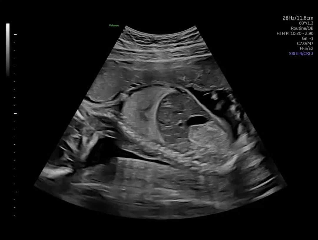 GeneralElectricのインスタグラム：「All right, Doc, the babies are ready for their close-up 📸  This is the Volusion Expert 22, one of @gehealthcare’s latest ultrasound systems, which uses Ultra HD to provide clear 2️D, 3D, and 4D images. Ultra HD has the innovative ability to capture those small details crucial to a fetus's development, like their heart, brain, spinal cord, kidneys, and other parts of their anatomy. 🧠🫀🤰  Ultrasound technology also improves women’s health and diagnosis at all stages. From evaluation and treatment of infertility, identifying a blockage in the fallopian tubes, identifying endometriosis, and more, women receive better quality care.   #HowWeGEek #GeekOutWithGE」
