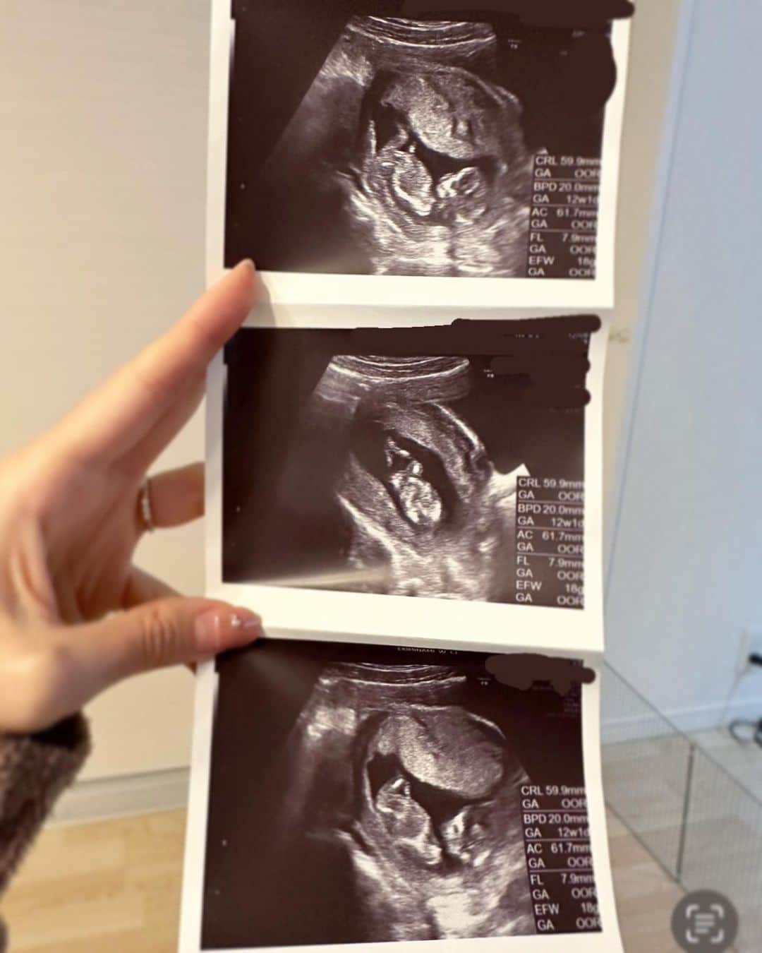 毛利佳納子さんのインスタグラム写真 - (毛利佳納子Instagram)「【ご報告】  新年明けましておめでとうございます🎍☀️ 新年早々、私事にはなりますが、、  この度、お腹の中に 赤ちゃんを授かりました👶🏻🥰✨  無事に安定期に入り、 6月に出産予定です💐  ※写真の3枚目は初めて病院に行った日、 4枚目は最近のエコー写真🥰 もうこんなに大きくなりました..💓    まず、たくさんご心配をおかけしてしまい 本当にすみませんでした😭💦 というのも、妊娠する少し前に "迷走神経反射"というもので意識を失って倒れ、 その少し後に妊娠したため、妊娠初期症状の体調不良を 完全に別の病気だと思い込んでしまい。😂 なので、妊娠に気付くまでに結構かかりました笑  あまりにコントロールできない謎の体調不良に 弱音を吐き、無駄に心配をおかけした後に 妊娠だとわかり、安定期に入るまで言えないもので ずっと申し訳なさでいっぱいでした😱💦 なのでやっと伝えることができて嬉しいです😭笑✨ 優しいお声掛けを本当にありがとうございました！！🙇‍♀️  妊娠だと発覚した時には、 まだ心の準備と環境も整えられていなかったので 驚きと戸惑いが正直大きかったです。  でも、妊娠検査薬で"陽性"反応を見た時、 産婦人科でエコーで赤ちゃんを確認できた時。 自分でもびっくりするくらいに 大号泣しました。 それは、120% "嬉しさと感動"でした。  自分の身体に命が宿ったということ。 これからお母さんになるということ。 決して当たり前ではなく、"奇跡"なんだということ。 本当にありがたくて嬉しくて。  「何があってもこの子を守りたい」 エコーで 小さい小さい赤ちゃんを この目で見た瞬間、心の中で 自然と強く、そう想いました。  (そんな強い決意とは裏腹に その後 訪れるそれはそれは壮絶なつわりに 「妊娠やめたい」「人間やめたい」と毎日泣くほど ネガティブおばけになっていましたが。💀笑)  また記録として、別の投稿でつわりについて 書かせていただこうと思います😂✨  つわりを乗り越え、今はだいぶ元気になり 大阪へも行けるようになりました🏃‍♂️！  これからは、なかなか今まで通りとはいかないけど 赤ちゃんが産まれるまで、できる限り友達にも会いたいし 仕事もやりきりたい！ 何より大事な赤ちゃんをしっかり産めるよう 体調にも気をつけながら、頑張っていきたいと思います！ YouTubeもここから再開していきます！😊  いつも温かい応援を 本当にありがとうございます🥲✨ これからも、今年も！ よろしくお願い致します😊🧡  読んでいただきありがとうございました🥰   #妊娠  #妊娠中期  #初マタ  #初マタニティ」1月1日 20時22分 - kanako_mouri