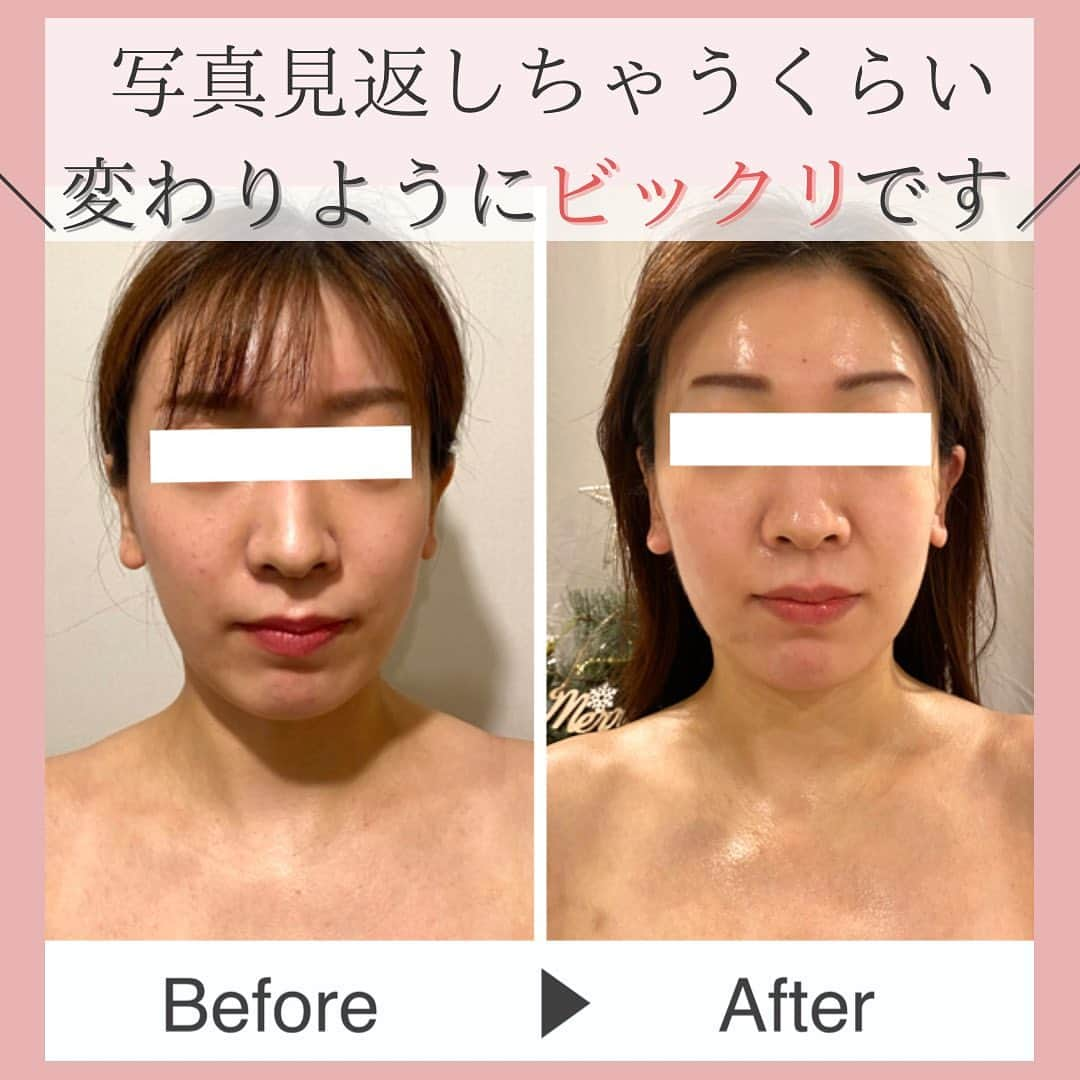 Eternal Total Beauty Salonのインスタグラム：「【何をしていても身体が軽いです♪】⁣ ⁣ ⁣ ⁣ どちらも真正面を向いて真っ直ぐ立っている⁣お写真ですが⁣ Beforeのお写真は首から向かって右側に⁣下がっており⁣ お顔も左右差があります🥺⁣ ⁣ ⁣ ⁣ Afterのお写真では⁣ 耳の見え方も平等になり⁣ 首も真っ直ぐになりましたね！⁣ ⁣ ⁣ ⁣ 首が歪んでいると⁣ 頭痛や肩こり、首こり⁣ そして疲れやすくもなります⁣ ⁣ そしてafterのお写真と比べると分かる様に⁣首が短くなってしまいます  ⁣ ⁣ ⁣ こちらを本来の正しい位置に戻す事で⁣首が長くなり⁣ お顔も小さく、左右対称に⁣ バランスの良いお顔になりますよ❤️⁣ ⁣ ⁣ 5〜6キロもある頭を支えてくれているので⁣ 下を向いてる時間が長かったら⁣ そりゃぁ負荷がかかりますよね👀⁣ ⁣ ⁣ ⁣ 本や携帯を見るときも極力⁣ 目線の高さまでもってきて⁣ 見るようにしましょうね！⁣ ⁣ ⁣ ⁣ お写真と嬉しいご感想もありがとうございます💕⁣ ⁣ ⁣ ⁣ ⁣ ⁣ ⁣ ⁣ ⁣ ⁣ 【ご新規様へ】⁣ 現在のご予約は平日のみ受け付けております。⁣ 1回のみでのご予約も可能ですが⁣初回含めまとめて3回分のご予約をオススメ致します。トップページのLINEから承っております🙇‍♀️⁣ ⁣ ⁣ ⁣ ⁣ 🌹オールハンド60分(ヘッド、小顔矯正、オイル)初回¥15000⁣ ⁣ 🌹インディバ付き90分(ヘッド、小顔矯正、インディバ、オイル) 初回¥20000⁣ ⁣ ⁣ ⁣ ⁣ ⁣ ＊＊＊＊＊＊＊＊＊＊＊＊＊＊＊＊＊＊＊＊⁣ ⁣ ⁣ 小顔矯正/インディバエステ⁣ ⁣ ⁣ 営業時間　11:00〜20:00(18:30最終受付)⁣ ⁣ 定休日　不定休⁣ ⁣ ⁣ ご予約はDMもしくはLINEから🙇‍♀️✨⁣ 【@beautylian_kogao】⁣ ⁣ ＊＊＊＊＊＊＊＊＊＊＊＊＊＊＊＊＊＊＊＊⁣」