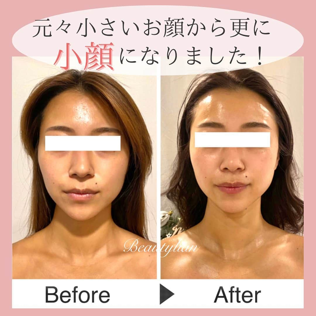 Eternal Total Beauty Salonのインスタグラム：「【変わらないお顔はない♪】⁣ ⁣ ⁣ ⁣ ウェディング撮影に向けて通って⁣下さっていたお客様👰‍♀️✨⁣ ⁣ ⁣ ⁣ 元々フェイスラインもシャープで骨格も小さいお客様でしたが⁣ 更にちいさく⁣ 左右差整い⁣ クマも薄くなりましたね！⁣ ⁣ ⁣ ⁣ ⁣ 色んな角度からお写真撮られるので⁣そこもバランスを見ながら⁣ 左右差を整えていきましたよ💕⁣ ⁣ ⁣ ⁣ 撮影当日まで身体作りも⁣ 凄い努力されていて尊敬🥹⁣ ⁣ ⁣ ⁣ ⁣ 生きてる限り誰しもが⁣ 老化や重力には逆らえないし⁣ 癖の積み重ねで⁣ だんだんとお顔が変わり 気になる所が⁣増えてくるかもしれませんが⁣ ⁣ ⁣ ⁣ 5年前位のお顔には戻せます♡⁣ 年齢関係なく、変わらないお顔は⁣ないですよ🤲⁣ ⁣ ⁣ ⁣ ⁣ お客様ご自身のインスタにも⁣ Upして⁣下さっていました！⁣ @mikuchujo   実家に帰ってきたような多幸感に包まれるって 何とも嬉しすぎます ありがとうございます🧡  ⁣ ⁣ ⁣ ⁣ ⁣ ⁣ ⁣ 【ご新規様へ】⁣ 現在のご予約は平日のみ受け付けております。⁣ 1回のみでのご予約も可能ですが⁣初回含めまとめて3回分のご予約をオススメ致します。トップページのLINEから承っております🙇‍♀️⁣ ⁣ ⁣ ⁣ ⁣ 🌹オールハンド60分(ヘッド、小顔矯正、オイル) 初回¥15000⁣ ⁣ 🌹インディバ付き90分(ヘッド、小顔矯正、インディバ、オイル) 初回¥20000⁣ ⁣ ⁣ ⁣ ⁣ ⁣ ＊＊＊＊＊＊＊＊＊＊＊＊＊＊＊＊＊＊＊＊⁣ ⁣ ⁣ 小顔矯正/インディバエステ⁣ ⁣ ⁣ 営業時間　11:00〜20:00(18:30最終受付)⁣ ⁣ 定休日　不定休⁣ ⁣ ⁣ ご予約はDMもしくはLINEから🙇‍♀️✨⁣ 【@beautylian_kogao】⁣ ⁣ ＊＊＊＊＊＊＊＊＊＊＊＊＊＊＊＊＊＊＊＊⁣」