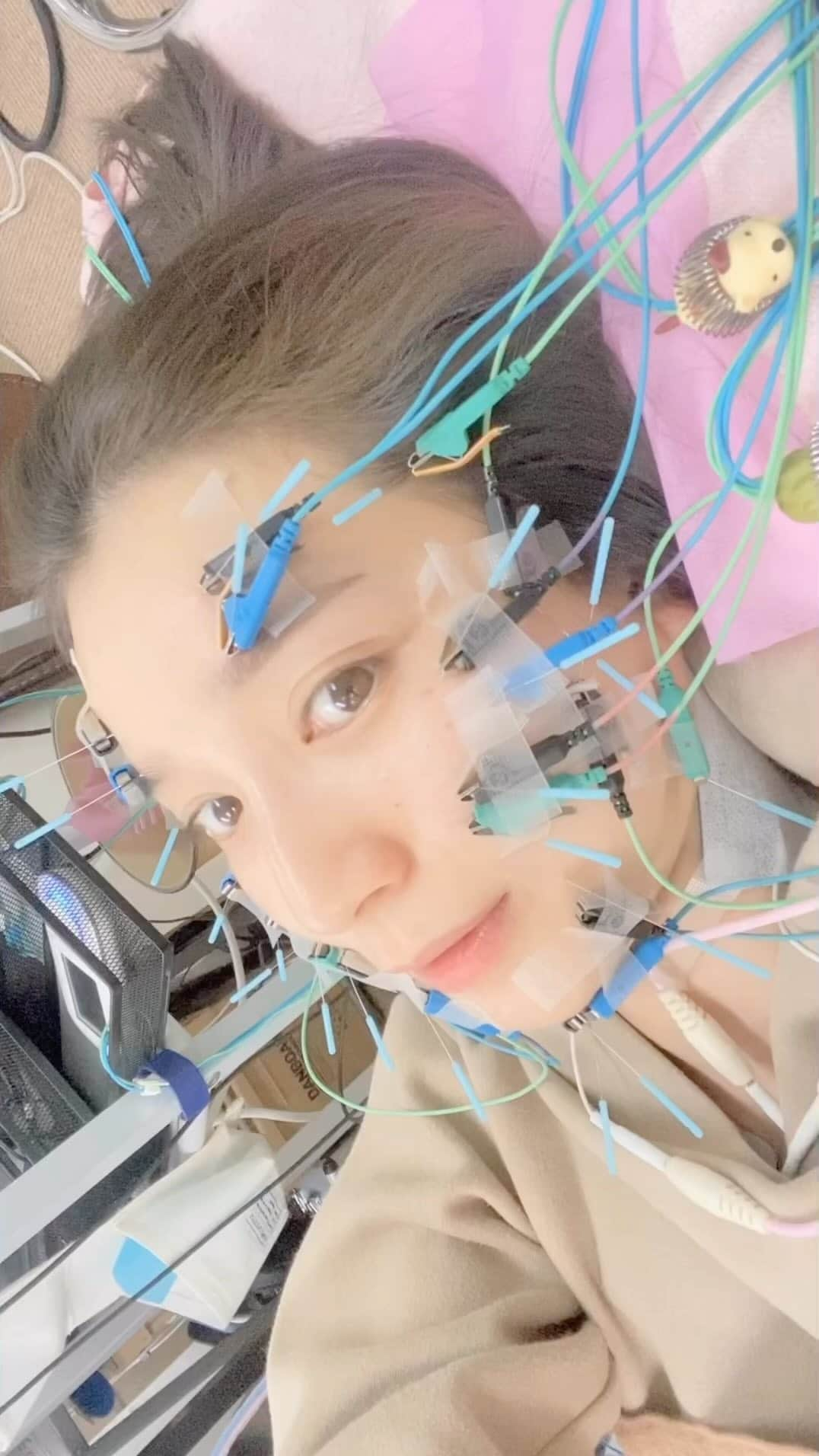 芹那のインスタグラム：「#人造人間芹那 🤖  ちょっと待って❕❕❕❕❕ なんかハリネズミみたいなのいない❔🦔✨💫 施術中は見えないから気づかなかったんだけれど 動画見てたら なんか見切れてるんだけれど😂😂😂 なんですかこれ❔ ２匹いる🤣❣️❣️❣️❣️ @bodyremaker.2018 💆🏻‍♀️  顔にたくさんの鍼が刺さっていて その鍼から 電気が流れているため ピクピクしていて うまく顔がうごさせない状況です🤪 わたしは電流わりとMAXで流していただく派です 一回で目はぱっちり＆リフトアップされて毎回驚きの効果です❣️  あとは 体の歪みや 腰痛や肩こり すぐに良くしていただけるの😌👏🏻 メンバーとか周りのお友だちも通っているので、 伝言頼んだり、 物渡していただいたり、 時には漫画読んだりYouTubeみたり長居させていただいたり 友だちと遭遇して そのままおしゃべりに花咲かせたり いろんな意味で居心地の良い場所です🫶🏻💓🤍 今年もお世話になりました😚✌🏻❕❕  #美しくなりたい #美しくなりたい人と繋がりたい #キレイになりたい #キレイになりたい人と繋がりたい #美容鍼 #浅草橋整体 #リフトアップ #アンチエイジング #整体院 #整骨院 #美容好きさんと繋がりたい #美容女子 #美容オタク #bodymake #ボディメイク #腰痛改善 #肩こり解消 #肩こり改善 #肩こり#腰痛解消 #体の歪み   BODYREMAKER 鍼灸治療院・整体院 東京都台東区浅草橋2-2-3大島ビル1F.」