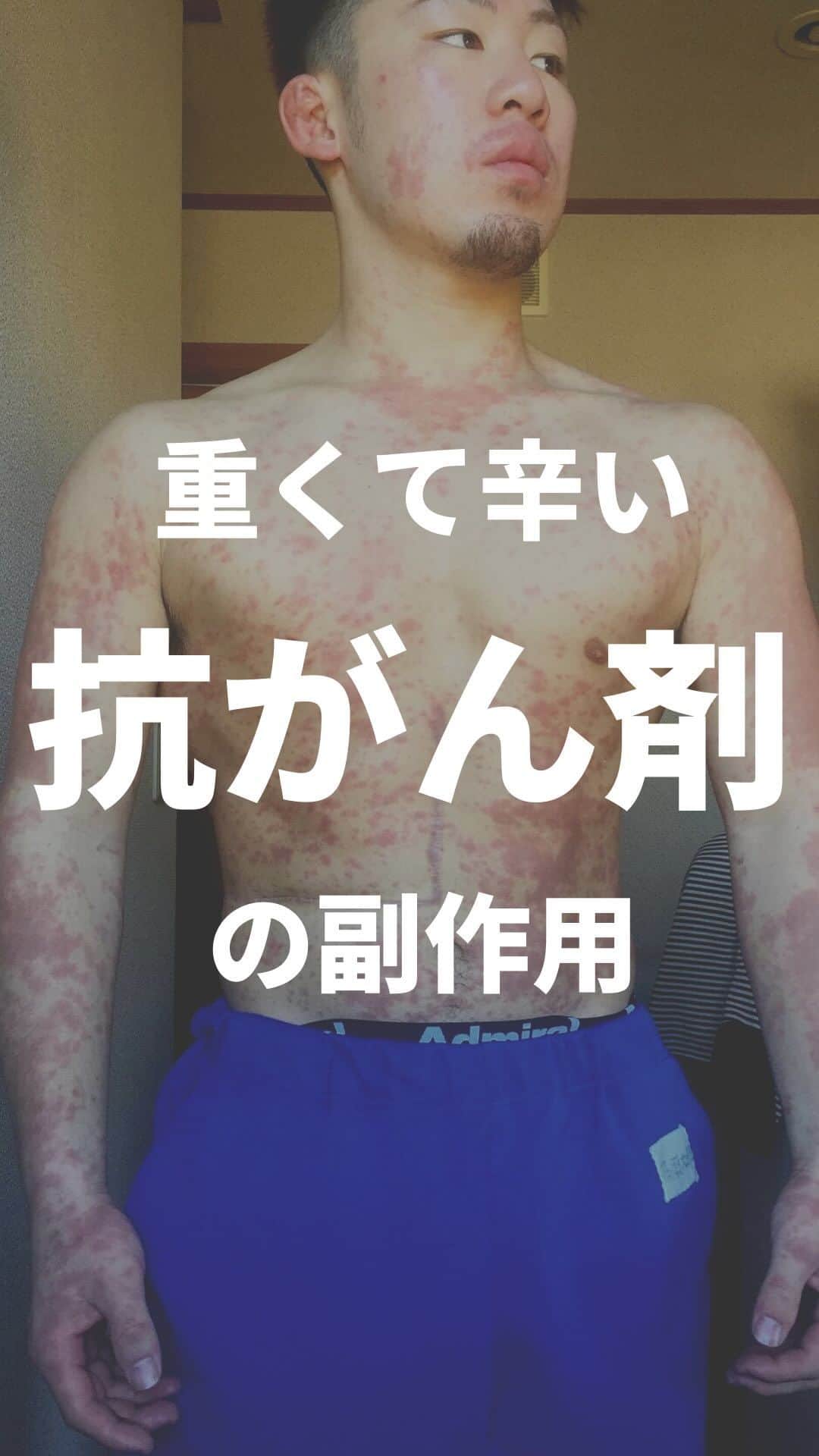 高須将大のインスタグラム：「抗がん剤の副作用を経て #開腹手術　#抗がん剤 #癌 #ステージ4  #肝臓がん　#抗癌剤　#肝臓癌　#AYA世代　#笑顔　#余命　#がん　#癌 #再発　#がん　#RIZIN #総合格闘技　#格闘技　#キックボクシング」