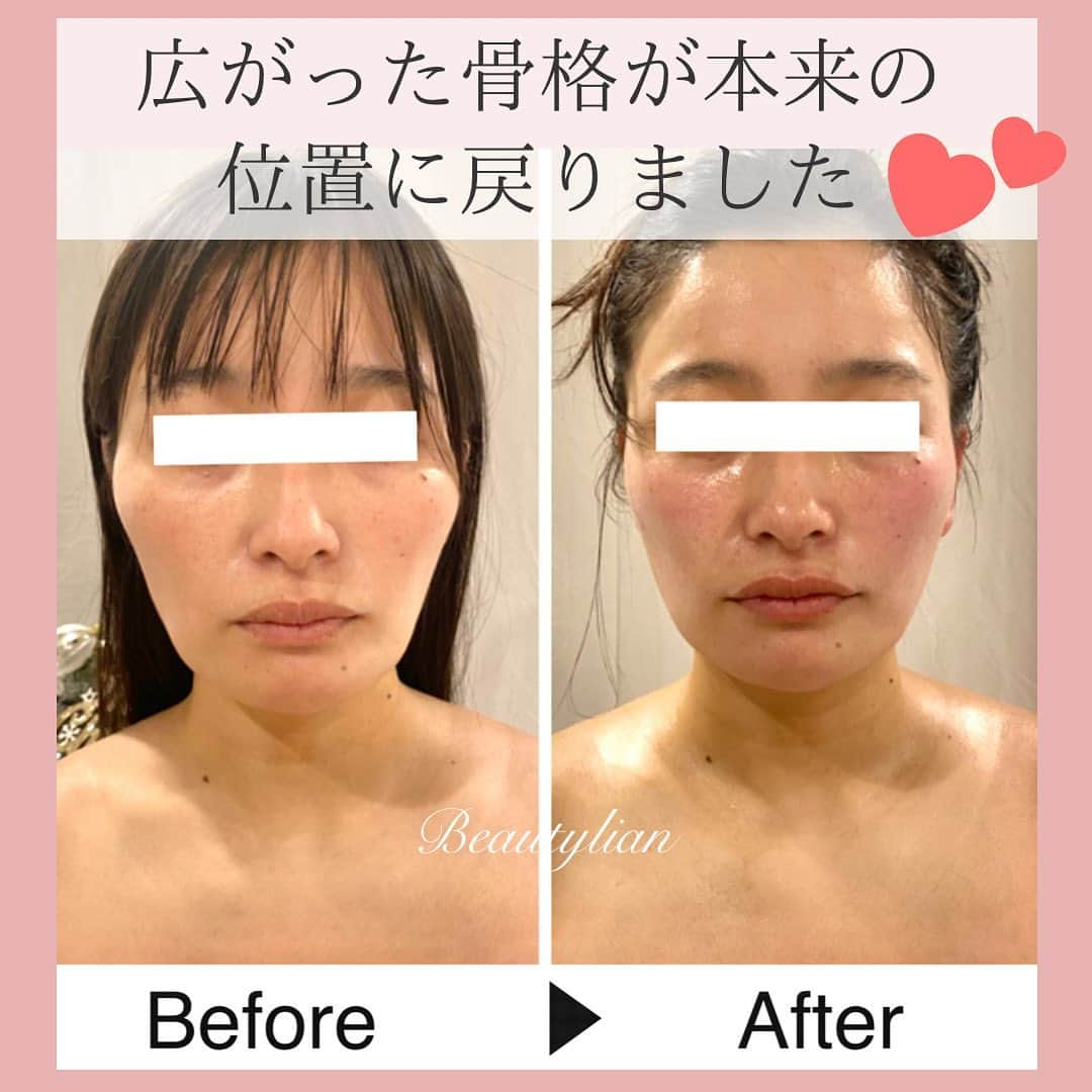 Eternal Total Beauty Salonさんのインスタグラム写真 - (Eternal Total Beauty SalonInstagram)「【広がった骨格は正しい位置に戻ります】⁣ ⁣ ⁣ ⁣ 昔はこんなに気にならなかったのに・・・⁣ ふと鏡を見た時に私こんな顔だったっけ？⁣ ⁣ ⁣ ⁣ と思う方も多いと思います🥺⁣ ⁣ ⁣ 遺伝からの生まれつきの骨格は別として⁣ そもそも、なぜ頬骨が出っ張ってくるの？？⁣ それは⁣ ⁣ ⁣ ⁣ ⁣ 《姿勢や、日常生活の癖》が原因のパターンが多いです。⁣ ⁣ ⁣ ⁣ 癖に関して具体的には⁣ 頬杖をつく、うつ伏せ寝、歯ぎしり、片方で食べるなどです⁣ ⁣ ⁣ ⁣ 後は⁣ スマホ見る時など下を向く姿勢が長かったり⁣ PCなど眼を使う事が多いと⁣ 頬骨と繋がっている側頭筋が硬くなりそれに⁣ 引っ張られて頬骨が横に広がってきてしまうんです💦⁣ ⁣ ⁣ ⁣ なので！頭の横の側頭筋をほぐしてあげる事も⁣とても重要💆‍♀️⁣ ⁣ ⁣ ⁣ お顔はたるみに繋がるのでご自分での⁣マッサージは極力避けて頂きたいのですが⁣ 頭皮は緩めてあげましょう！⁣ ⁣ ⁣ ⁣ ⁣ ⁣ お写真のお客様は3回目でしたが⁣頬骨の出っ張りが内に入り⁣ お顔のバランスや左右差も整いましたね！⁣ ⁣ ⁣ ⁣ 1回目より2回目、3回目の方が⁣ 変わり幅も大きくなり⁣ 戻りずらくもなりますよ🤲⁣ ⁣ お写真ありがとうございます💓⁣ ⁣ ⁣ ⁣ ⁣ ⁣ ⁣ ⁣ ⁣ ⁣ 【ご新規様へ】⁣ 現在のご予約は平日のみ受け付けております。⁣ 1回のみでのご予約も可能ですが⁣ 初回含めまとめて3回分のご予約をオススメ致します。トップページのLINEから承っております🙇‍♀️⁣ ⁣ ⁣ ⁣ ⁣ 🌹オールハンド60分(ヘッド、小顔矯正、オイル)初回¥15000⁣ ⁣ 🌹インディバ付き90分(ヘッド、小顔矯正、インディバ、オイル) 初回¥20000⁣ ⁣ ⁣ ⁣ ⁣ ⁣ ＊＊＊＊＊＊＊＊＊＊＊＊＊＊＊＊＊＊＊＊⁣ ⁣ ⁣ 小顔矯正/インディバエステ⁣ ⁣ ⁣ 営業時間　11:00〜20:00(18:30最終受付)⁣ ⁣ 定休日　不定休⁣ ⁣ ⁣ ご予約はDMもしくはLINEから🙇‍♀️✨⁣ 【@beautylian_kogao】⁣ ⁣ ＊＊＊＊＊＊＊＊＊＊＊＊＊＊＊＊＊＊＊＊⁣ ⁣」1月10日 20時33分 - kogao_beautylian