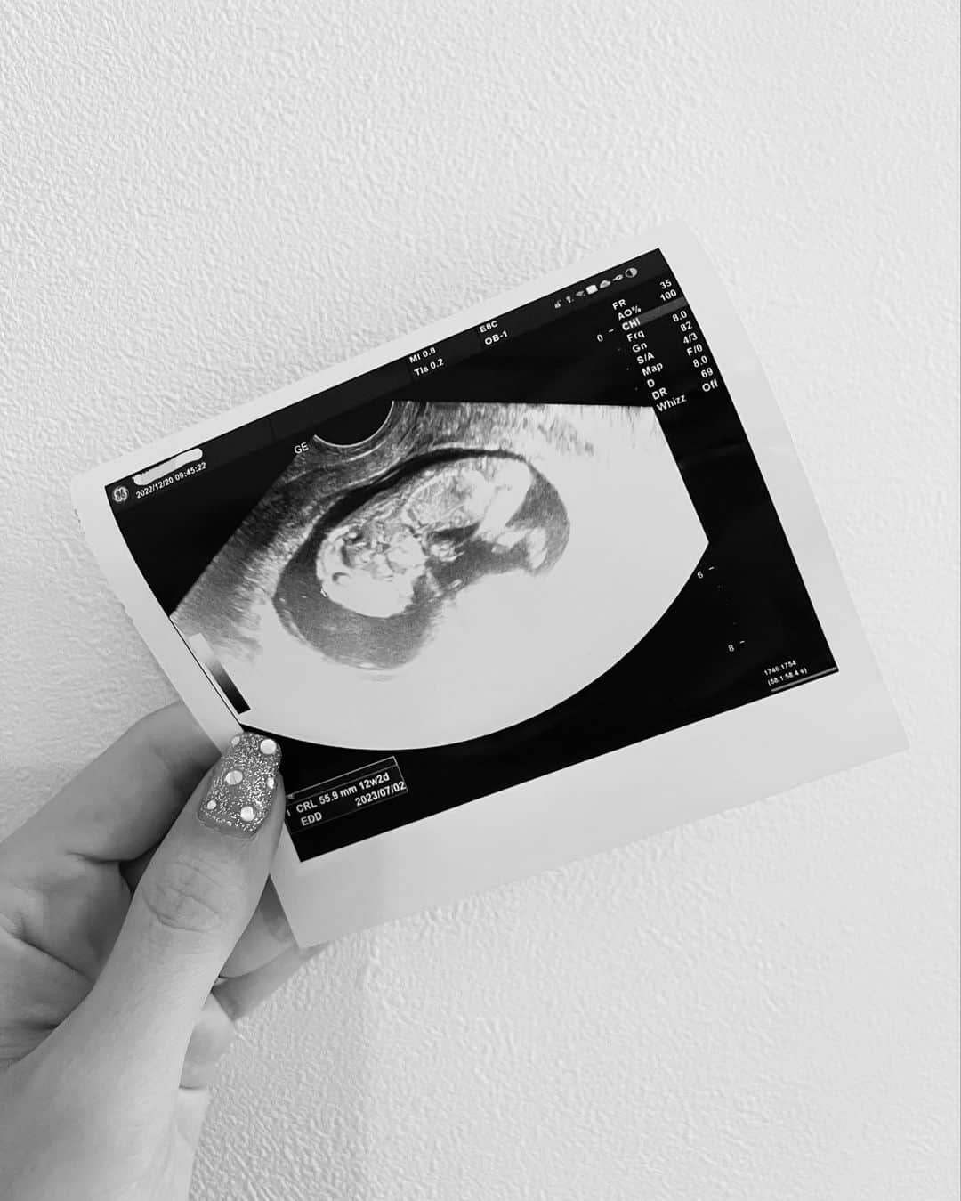 木村安梨沙さんのインスタグラム写真 - (木村安梨沙Instagram)「ご報告🌈 この度、第2子を授かりました👶🏻💫 安定期に入りましたので皆様にもご報告を。  妊娠5ヶ月目に入り 久しぶりの妊婦🤰生活を楽しんでます✌️ 今回も絶賛食べ悪阻です🍙  まだまだ安心というわけにはいかないですが 月1の検診で元気に育っていく姿を見て ふと一安心の繰り返しです😂❤️  予定日は今年の7月。 それまでは暖かく見守ってください🐥✨  残りの妊婦生活も楽しみます❤️（笑）」1月17日 21時34分 - arisa1208