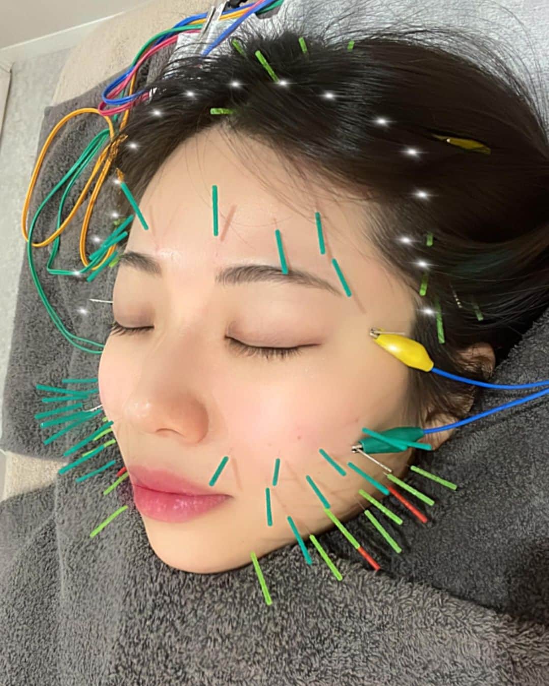鈴木ふみ奈のインスタグラム：「長年お世話になってる金髪院長の杉崎先生のとこに行ってきたよ👨‍⚕️🪡  杉崎先生のところに行き始めてから、浮腫にくくなって顔がスッキリした😳いつもありがとうございます✨  プライベートの友達も気に入って通ってくれてる子いるの🐰そのくらいおすすめ💓」