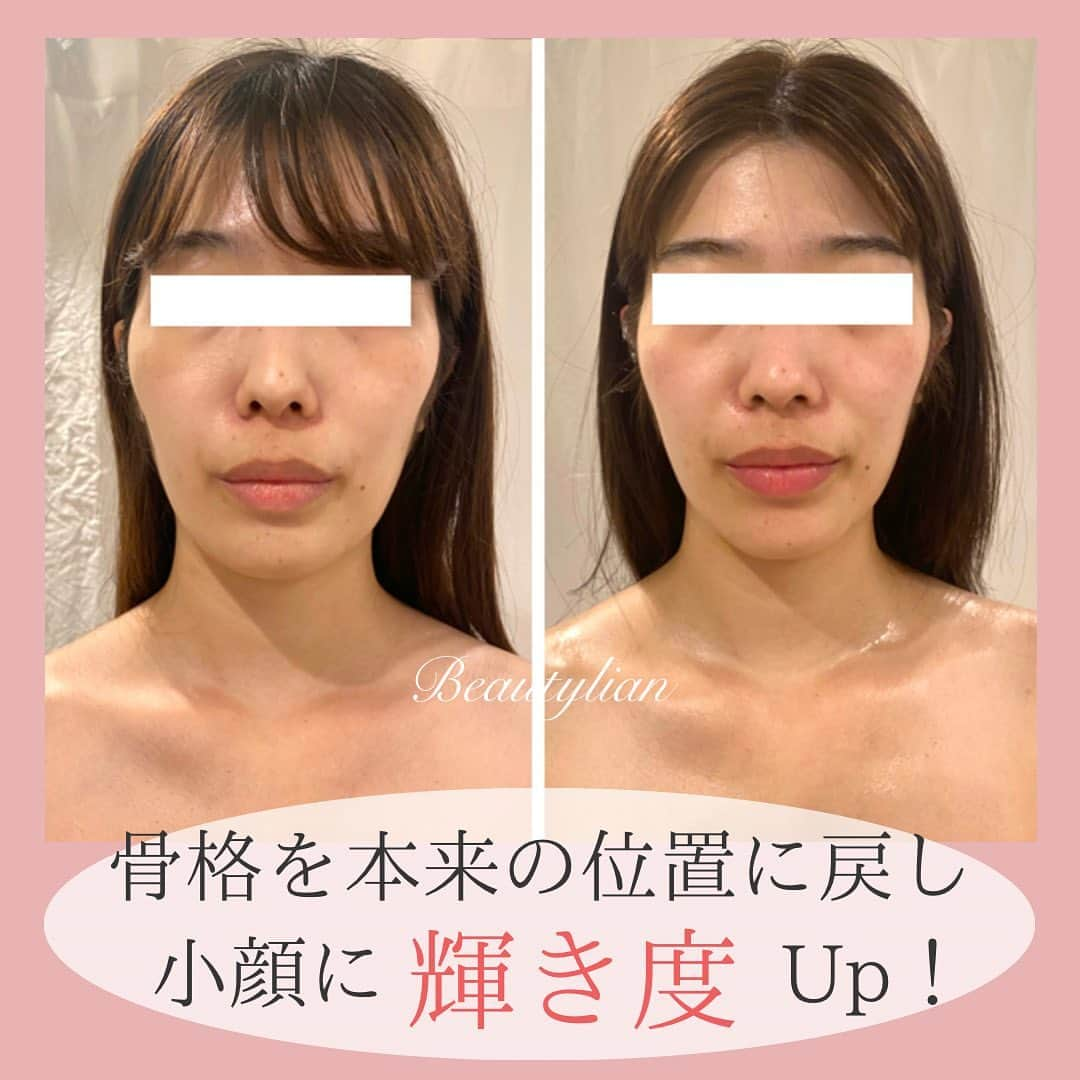 Eternal Total Beauty Salonのインスタグラム：「【広がった骨格を戻して本来のお顔へ♪】 ⁡ ⁡ ⁡ ご紹介で挙式に向けてご来店下さっているお客様🥰 ⁡ ⁡ 頬骨の出っ張りが内に入り 縦にも小さくなりましたね ⁡ ⁡ ⁡ 癖などで左右差があったり 広がった骨格はちゃんと本来あるべき位置に戻せますよ✨ ⁡ ⁡ ⁡ また、小顔効果やより若々しい印象になるにはお顔の下半分や目元がとっても重要です！ ⁡ ⁡ ⁡ 首からお顔の筋肉も繋がっているのでほぐしてほぐして🤲 (力強いマッサージはしません) ⁡ ⁡ ⁡ こちらのビフォーアフターは 3回目になります 3回目までの期間を週1〜10日に1回ペースで お越し頂く事で戻りにくく そして変化も大きくなりますよ❣️ ⁡ ⁡ ⁡ ⁡ 皆さんのお悩みが少しでも減り 自分を好きになったり 自信が持てる事で可能性が広がり何か一つでも行動が変わる きっかけになれたら嬉しいです🫶 ⁡ ⁡ ⁡ ⁡ ⁡ ⁡ ⁡ ⁡ ⁡ ⁡ 【小顔効果倍増なペース】 ＊初回から含めて3回目までは週1から空けても2週に1回のペースを推奨しております。 最初に土台を作り戻りにくく定着させる為です。 ⁡ ご新規様は3回分のご予約をオススメ致します。トップページのLINEから承っております🙇‍♀️ ⁡ ⁡ ⁡ ⁡ 🌹オールハンド60分(ヘッド、小顔矯正、オイル)初回¥15000 ⁡ 🌹インディバ付き90分(ヘッド、小顔矯正、インディバ、オイル) 初回¥20000 ⁡ ⁡ ⁡ ⁡ ⁡ ＊＊＊＊＊＊＊＊＊＊＊＊＊＊＊＊＊＊＊＊ ⁡ 目黒駅東口徒歩7分 小顔矯正/インディバ ⁡ ⁡ 営業時間　11:00〜20:00(18:30最終受付) ⁡ 定休日　不定休 ⁡ ご予約はトップページのLINEから🙇‍♀️✨ 【@beautylian_kogao】 ⁡ ＊＊＊＊＊＊＊＊＊＊＊＊＊＊＊＊＊＊＊＊  #小顔矯正東京 #巻き肩解消 #小顔になりたい  #若返り効果 #えらはり改善 #エラ張り解消 #むくみ解消　#顔痩せ効果  #リフトアップ #かおやせ#ウェディングエステ #花嫁美容 #たるみ解消 #デコルテ#目黒小顔サロン #むくみ対策  #ほうれい線改善#小顔サロン東京」