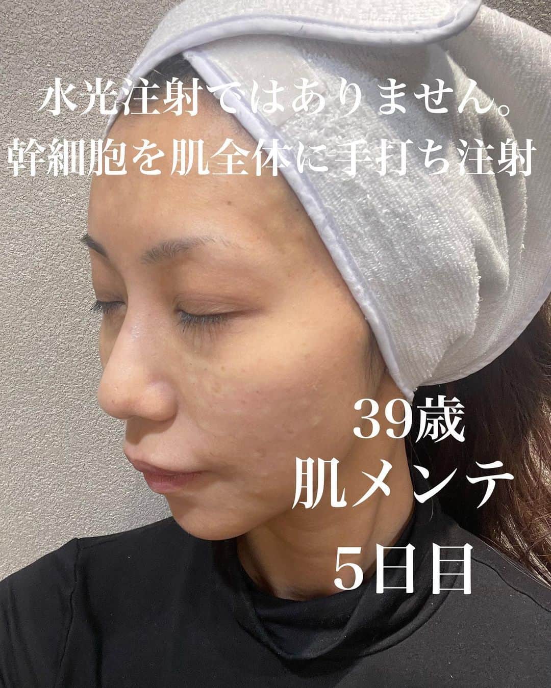 松枝明葉のインスタグラム：「良い薬剤は手打ちに限る💉という看護師さんの話から幹細胞を全体に注射した件でレポ  ＝＝＝＝＝ 通常は水光注射等で入れる クリニックさんもあるんですけど、  どのくらい肌に入ってるか わからない部分もあるとの噂。  良い薬剤はガッツリ注射で 必要量をダイレクトに入れた方が 良い！！！！とのことでございます  なのでウチは水光注射は 扱ってません @ginza_78_clinic @ginza78clinic_nurse   ＝＝処置＝＝  麻酔と一緒に注射するので 肌に入れる時の痛みはなし。  処置後の腫れもほぼなし✨ ↑ やっぱり注射なので全体ポテっと 浮腫んでる感はある  先生と話ながら15分程度で終了〜  ダウンタイム30分程度で 注射のプクっとした感じも なくなります。 (夜飲みの約束あったの忘れてて すっぴんでいきましたww) ＝＝＝＝＝＝＝＝＝＝＝＝＝  あくまでも個人的な体験感想なので 「効果あるよ」とは言い切れない 部分もありますけど、  現在、なんと！！  幹細胞のおかげか 目の下たるんで少し脂肪が 気になってたものが 無くなった感アリ‼️👏  糸やった浮腫もシュッとなくなり 顔のハリと涙袋が少し復活✨  嬉しい...笑  注射の針はすんごく細いんだけど やっぱり注射を顔に打つのは ちょっとコワイよね笑  #歯髄幹細胞 #幹細胞 #きれいになりたい #アラフォーママ #アラフォー女子 #ベストコスメ #美容医療 #美容皮膚科 #水光注射 #アラサー #アラサーコーデ #ginza78clinic #銀座 #ginza #アラフォー美容 #整形」