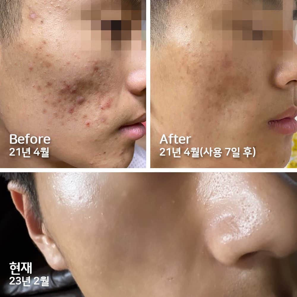 パク・タミのインスタグラム：「- 맞아요^^ 같은 분이세요~~  '이제 엄마가 쓰라는거 안쓸거야. 엄마가 쓰라는거 다 써도 안좋아지잖아..'  정말 좋다는 화장품은 비싼것부터 소문난것까지 다 써봤다던 고객님. 폴라탐을 쓴 아들의 피부가 달라지는걸 보시더니 이 상황을 꼭 알리고 싶으시다며 제게 디엠을, 또 본사로도 연락을 주셨었어요. 그게 2021년 4월...  이 남학생 얼굴 보신분들 있으실거예요. 피부 트러블이 얼마나 고민인지를 누구보다 잘 아시는 분이었었기에, 폴라탐 시카라인을 알리고 싶으시다고 사진을 주셨었거든요.  2년이 다 되어가는 오늘. 오전에 또 연락을 주셨어요.  '대표님 시카 프로모션 너무 감사해요. 올해 스무살이 된 아들 피부 더 좋아졌어요. 그리고 지속력이 좋은게 여드름이 잘 안생겨요. 피지압출안하면 안됐는데 지금은 압출할 갯수가 몇개 안되요. 아들 장가 보낼때까지 시카 잘 부탁해요.'  이분과 꼭 통화를 해보고 싶더라구요. 오전에 시카 오픈으로 바쁜중이었지만, 꼭 대화를 하고 싶어서 제가 번호를 받아 전화를 드렸어요.  통화하는 내내 아들을 생각하는 엄마의 정성에 놀랐어요. 아끼는 마음이 전화선 넘어로도 충분히 느껴져서..  이전엔, 연예인이 만들거나 소개하는 건 신뢰를 안가지셨다고, 연예인이라는 타이틀로 현혹하는 것 같아서. 그런데.. 폴라탐은 다르셨대요.  이젠 아드님도 엄마가 주시는 화장품에 신뢰를 갖게 되었고. 폴라탐을 찾는다고^^ 주변 여드름 있는 친척 조카들 챙기신다고 이번 프로모션때 20개 주문하신 고객님.  정말 좋아진 사진 또 보내주신다며 최근 사진을 주셨는데,  저희 모두 놀랐어요. 정말.. 피부가 너무 좋아져서...   저 폴라탐 더 열심히 할거예요! 정말 제대로! 저엉말 까다롭게 잘 만들어서 이런 기쁨 함께 누릴 수 있도록요! 이러려고 화장품 만드는 거 아니겠습니까!!  #폴라탐 @polatam_official」