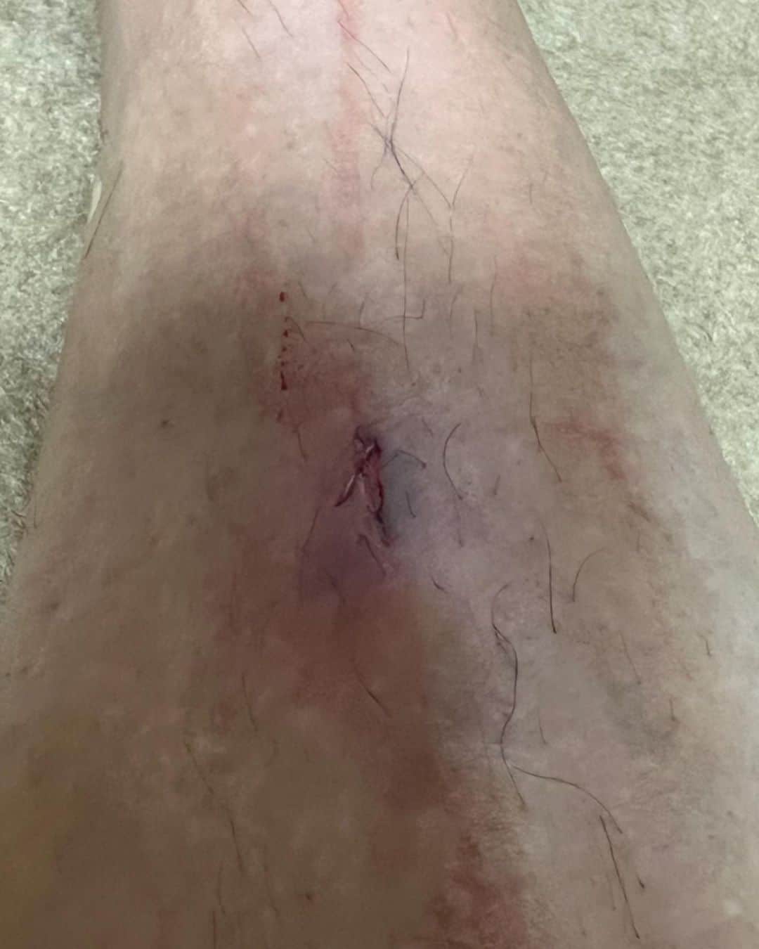 永田裕志さんのインスタグラム写真 - (永田裕志Instagram)「先日の後楽園ホールでの三冠戦で宮原選手の膝蹴り(ブラックアウト)にあわせてローキックをかましたら、脛が割れてしまいました。  痛みがまだまだ完全に無くなりません。  しっかり消毒しなきゃ。  恐るべし、ブラックアウト‼️  #triplecrown  #ブラックアウト  #脛が割れた #宮原健斗  #永田裕志  ##njpw  #ajpw」2月21日 15時34分 - yuji_nagata