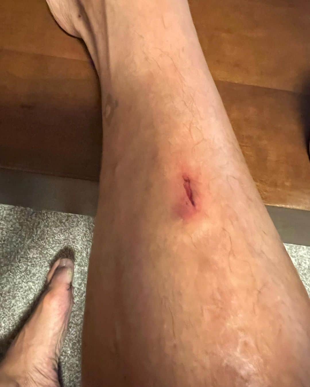永田裕志さんのインスタグラム写真 - (永田裕志Instagram)「先日の後楽園ホールでの三冠戦で宮原選手の膝蹴り(ブラックアウト)にあわせてローキックをかましたら、脛が割れてしまいました。  痛みがまだまだ完全に無くなりません。  しっかり消毒しなきゃ。  恐るべし、ブラックアウト‼️  #triplecrown  #ブラックアウト  #脛が割れた #宮原健斗  #永田裕志  ##njpw  #ajpw」2月21日 15時34分 - yuji_nagata