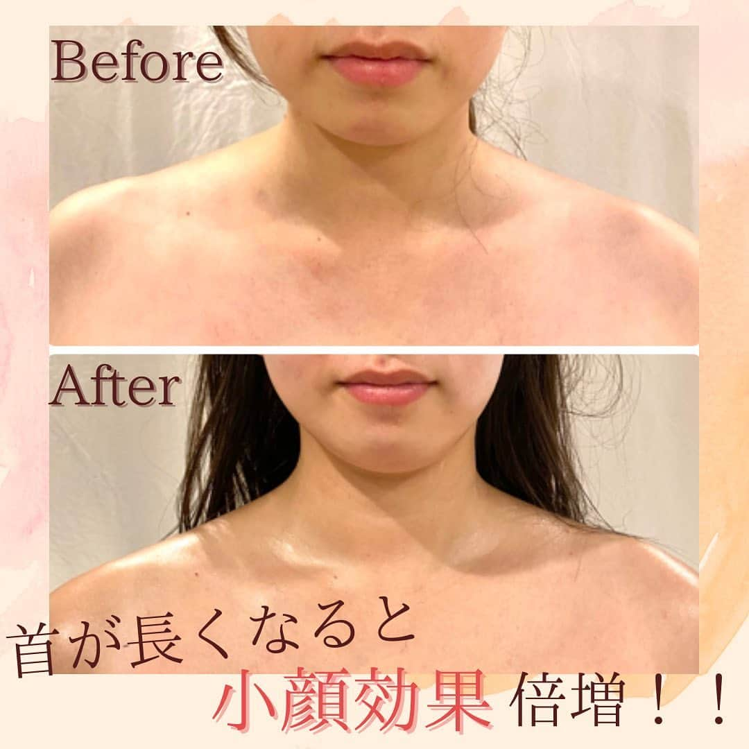 Eternal Total Beauty Salonのインスタグラム：「【スマホ首ってどんな状態？】⁣ ⁣ ⁣ ⁣ 皆さんご自分の首の位置って意識した事⁣ありますか？⁣ ⁣ ⁣ スマホ首やストレートネックという響きを⁣耳にする事多々あるかと思いますが、⁣ 具体的にどんな状態の事を指すの？⁣ スマホ首って良くなるの？⁣  ⁣ ⁣ ⁣ 現代病とも言われるスマホ首⁣ 本来私たちは腰から脊柱までS字カーブになっているのが通常ですが⁣ ⁣ ⁣ スマホやPCなど下を向く態勢が多いと⁣肩が内巻きで猫背になり首が前に出ている状態です。⁣ ⁣ ⁣ ⁣ この状態が続くと首の前側の筋肉が張って硬くなり⁣ 顔のたるみや二重顎、ほうれい線の⁣原因にもなるんです😱⁣ ⁣ ⁣ ⁣ ⁣ ⁣ サロンにお越し下さるお客様⁣ スマホ首になっている方非常に多いです🫢⁣ ⁣ ⁣ ⁣ ⁣ ただ、お写真のお客様の様に⁣ 硬くなった筋肉を解してあげると本来あるべき位置に、⁣ ⁣そして首も本来の長さに戻ります✨ ⁣ ⁣ 3枚目からの自宅でも出来る簡単なストレッチもぜひ続けてやってみてくださいね♡⁣ ⁣ ⁣ ⁣ ⁣ ⁣ ⁣ ⁣ ⁣ ⁣ ⁣ 【ご新規様へ】⁣ 現在のご予約は平日のみ受け付けております。⁣ 1回のみでのご予約も可能ですが⁣ 初回含めまとめて3回分のご予約をオススメ致します。トップページのLINEから承っております🙇‍♀️⁣ ⁣ ⁣ ⁣ ⁣ 🌹オールハンド60分(ヘッド、小顔矯正、オイル)初回¥15000⁣ ⁣ 🌹インディバ付き90分(ヘッド、小顔矯正、インディバ、オイル) 初回¥20000⁣ ⁣ ⁣ ⁣ ⁣ ⁣ ＊＊＊＊＊＊＊＊＊＊＊＊＊＊＊＊＊＊＊＊⁣ ⁣ ⁣ 小顔矯正/インディバエステ⁣ ⁣ ⁣ 営業時間　11:00〜20:00(18:30最終受付)⁣ ⁣ 定休日　不定休⁣ ⁣ ⁣ ご予約はDMもしくはLINEから🙇‍♀️✨⁣ 【@beautylian_kogao】⁣ ⁣ ＊＊＊＊＊＊＊＊＊＊＊＊＊＊＊＊＊＊＊＊⁣ ⁣ #顔の歪み改善⁣ #小顔矯正東京 #巻き肩解消 #小顔になりたい  #結果の出るサロン#えらはり改善 #エラ張り解消 #むくみ解消　#顔痩せ効果  #リフトアップ #かおやせ#ウェディングエステ #花嫁美容⁣ #たるみ解消 #鎖骨　#デコルテ#目黒小顔⁣#ほうれい線改善#小顔サロン東京  ⁣ ⁣ ⁣」