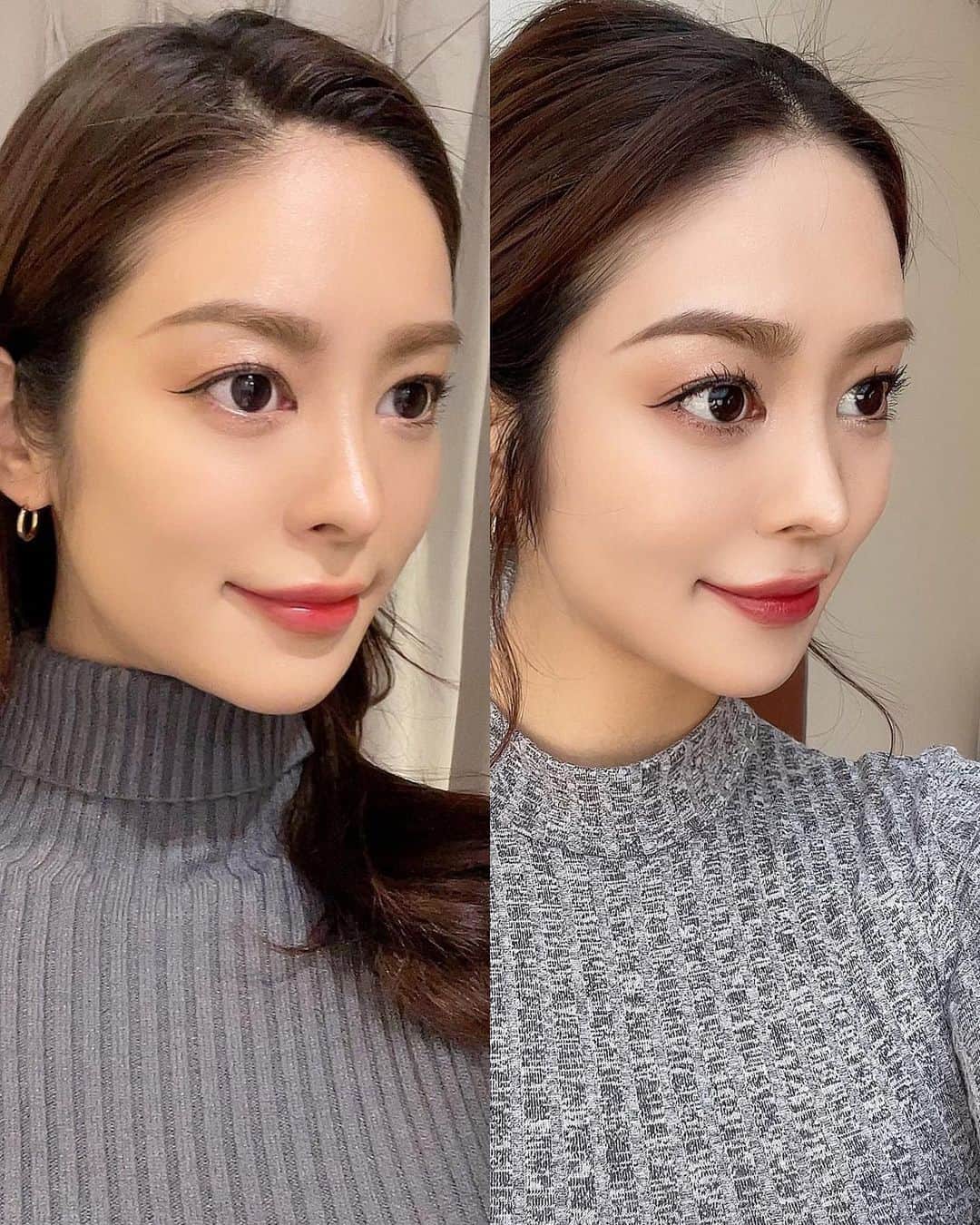 大柳麻友さんのインスタグラム写真 - (大柳麻友Instagram)「⁡ ⁡ 最近、美容に力を入れ始めた✌︎ ⁡ @aelle_clinic の @dr.wakura 小顔先生こと和倉先生にもっとキュンするリフトの施術していただきました🫶 ⁡ 初めてのリフトだったけど、丁寧にカウンセリングして頂いて 中顔面があっという間に短くなったー！✨ 大満足です😚😚 ⁡ 和倉先生ありがとうございました🫶 ⁡ ⁡ ⁡ #小顔先生 #キュンするリフト #もっとキュンするリフト #aelleclnic #アエルクリニック表参道 #糸リフト #小顔 #和倉先生 #美容#美容整形 #PR ⁡」1月31日 20時06分 - mayu_oyanagi