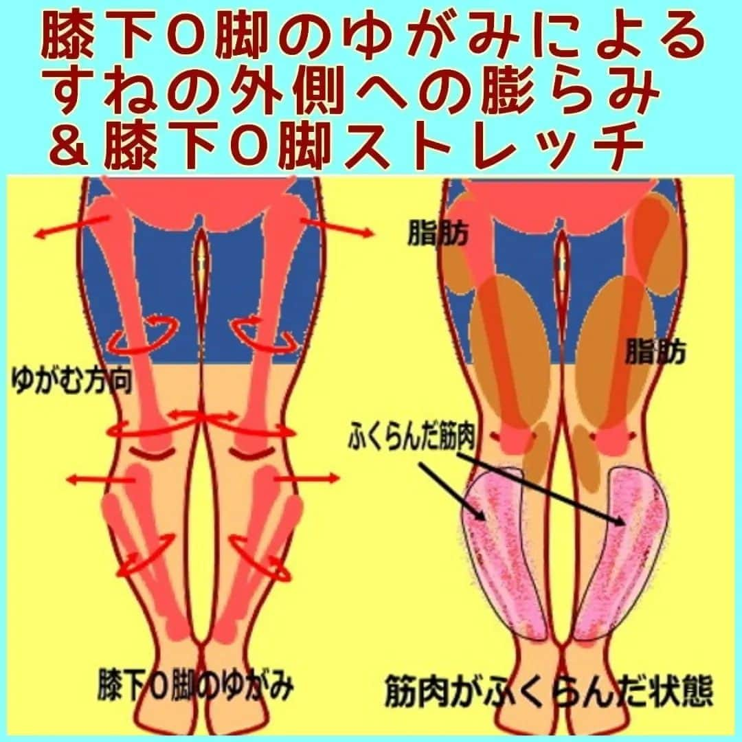 中目黒整体レメディオ 院長　渡邉潤一さんのインスタグラム写真 - (中目黒整体レメディオ 院長　渡邉潤一Instagram)「すねの部分が外側に膨らんでいると、膝下が曲がって見えます。 これは、膝下の関節のゆがみにより、すねの筋肉（前脛骨筋）が硬くなっているからです。  膝下がゆがんでいる場合、すねの骨（脛骨）が外側に歪んでいます。 これは重心が外側にきていることで起こり、そのバランスを保とうとする事が原因です。 他にも骨盤の広がりや、太もものねじれなどを支えるためだとも考えられます。  筋肉が収縮するときの特徴として、硬くなると膨らむという性質があります。 たとえば、力こぶを作ると上にもりあがるような事です。  すねの骨のゆがみにより、すねの横の筋肉（ピンク部分）が緊張し上下に収縮します。 それにより前に膨らむような形状になります。  この状態が常に起きていると、筋肉は膨らんだままになります。 また、その部分の神経もそれが正常であると誤解し、その状態を維持してしまいます。  これが、すねの筋肉が硬くなったことにより、正面から見るとすねの骨が曲がっているように見せているのです。 . . ーーーーーーーーーーーーーーーーーーーーー  💮施術のご案内💮 中目黒整体レメディオ：骨盤・美脚コース 施術をご希望の方は、はHPの予約フォームか、 お電話（0357735977）にてご連絡ください。  ーーーーーーーーーーーーーーーーーーーーー  #大転子 #大転子矯正 #o脚 #x脚 #膝下o脚 #XO脚 #骨格矯正 #骨盤 #産後の骨盤 #下半身太り #ダイエット #太もも #ふくらはぎ #反り膝  #反り腰 #骨盤の歪み #整体 #レメディオ #姿勢矯正 #中目黒整体レメディオ #骨格診断 #脚痩せ」2月8日 15時33分 - remedio_watanabe