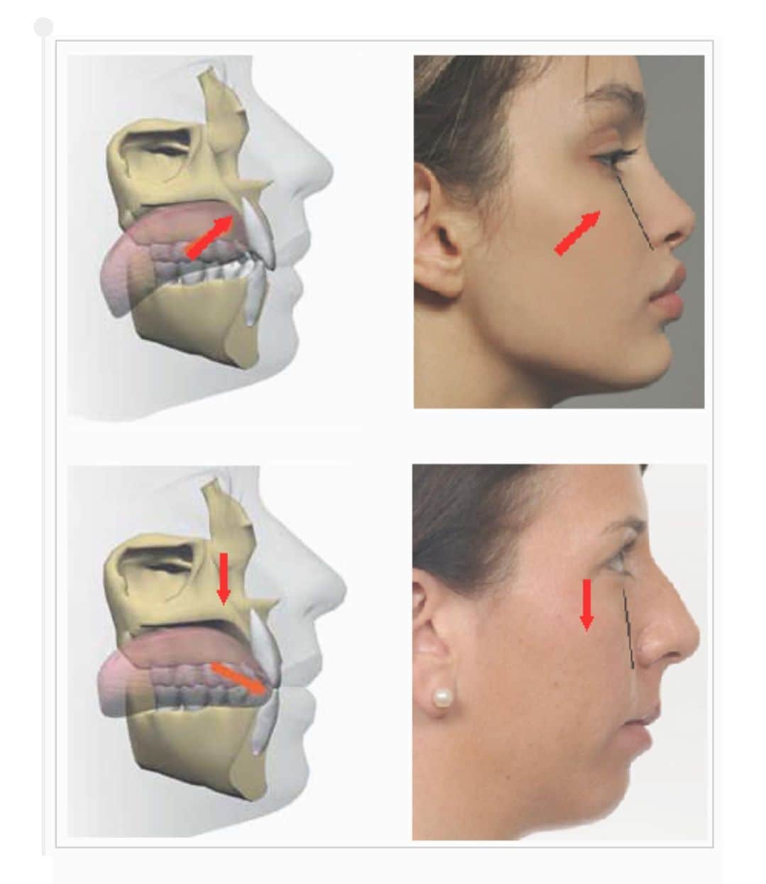 kogao283のインスタグラム：「舌の位置は上顎の変形に大きく影響します。 舌が正しい位置にない場合、頬骨、目のまわり、鼻の形、顔の長さ、唇の形や顎など違いが出てきます」