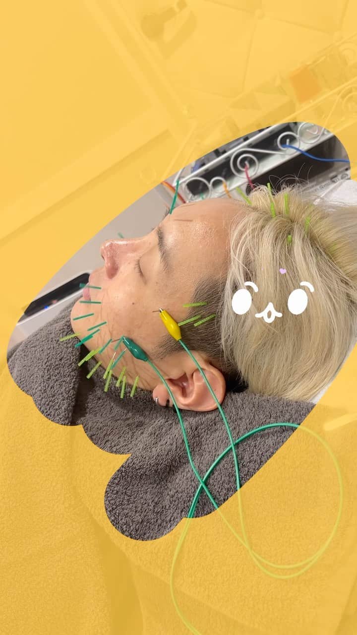tokuのインスタグラム：「美容鍼してもらいましたー☺️ ガルニデ楽屋に出張してくれたりお世話になってましたが、今日は本格的にハリネズミ🦔睡眠不足な顔に感動的な施術でした🥹  #金髪院長 @sugizakikenya @veline.venus #VeLine来たよ  #形状記憶美容鍼」