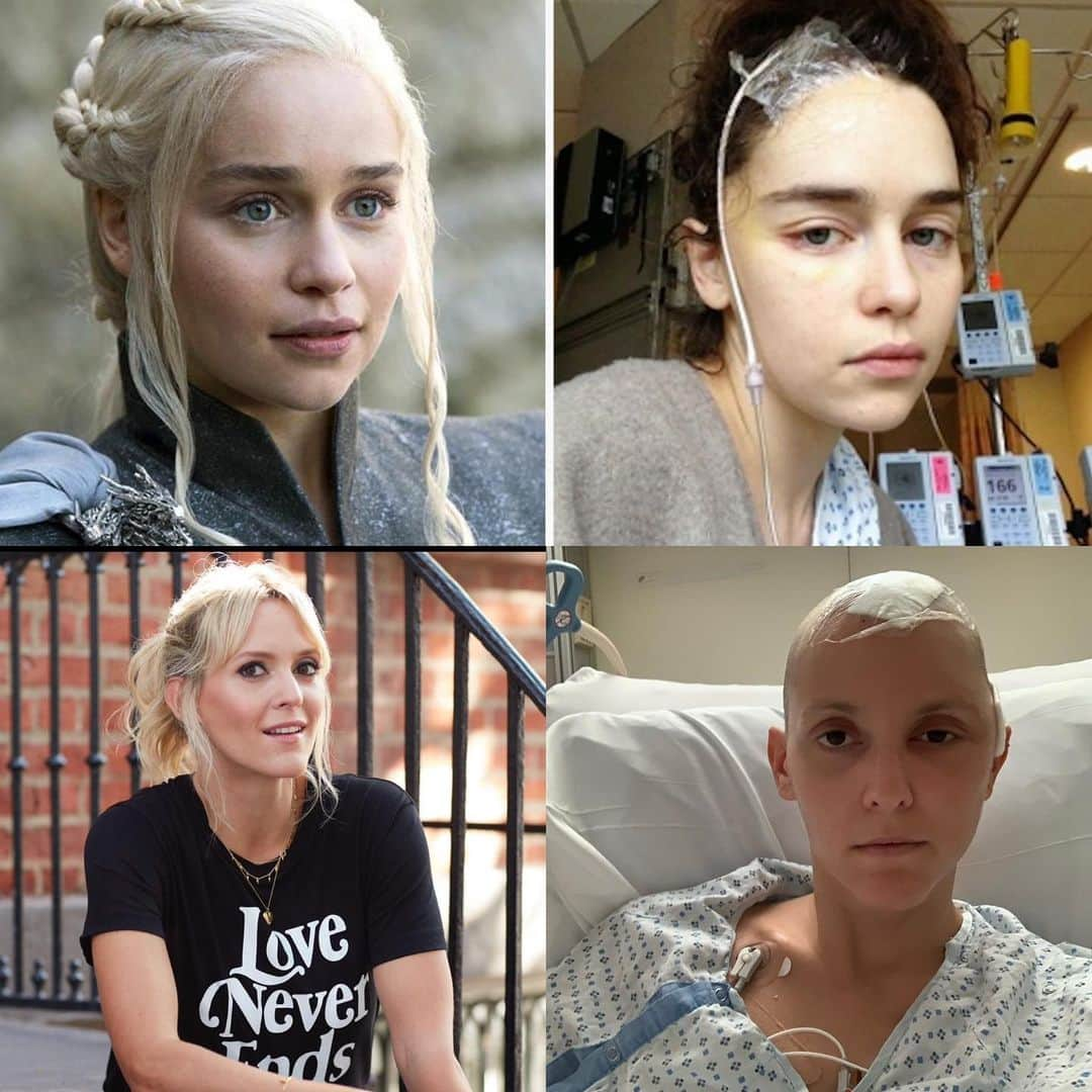 エミリア・クラークのインスタグラム：「Brain injury will affect 1/3 people in their lifetime. That’s one-third of all people globally.  Not just the elderly or the catastrophically unlucky.  Even the fantastically lucky who survive major brain injuries, like the amazing @emilia_clarke - who was very young, 24, when her first aneurysm began bleeding - or (young-ish) me - I was 38 when a previously undetected AVM ruptured, ending my ability to speak, compute language, move my right side; in short my life as I knew it.  Recovery from brain injury is an exhausting, complex, complicated, multi-factorial and well-nigh 24/7 constant struggle, even for those of us who have the privilege of getting to try.   But brain injury is still not talked about. And provision of vital services and care are not prioritised, even for the young people who might be able to give back to their communities and societies in a very meaningful way in the future.  Long-term critical neuro-rehabilitation and support are - even in the most medically advanced societies like the US and UK - practically nonexistent.  That’s why @emilia_clarke founded @sameyouorg with her amazing mum Jenny. And thanks to the phenomenal generosity of an anonymous donor in New York, *for the next 24 hours only*, ANY pledge of any donation, large and small, with no limit, will be 100% matched. That is unbelievable. The match offer will finish tomorrow night, Friday 17th February.  Obviously, we would be grateful to have your donation anytime, but if you have ever thought of supporting this very worthwhile cause, it would mean the world to us if you could find it in your heart to support SameYou’s vital mission and dig deep into your pockets TODAY to maximise the power of your donation.   I hate to scaremonger/point out the obvious, but on those odds, 1/3 of all people, it’s probably not unlikely that you or someone you love will need care for brain injury at some point in the future.  Thank you for all your support. It is so appreciated. Link in bio or visit SameYou.org 🙏🧠♥️  #braininjury」