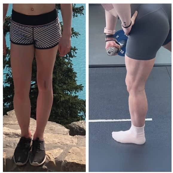 ナターシャ・ピュリッチのインスタグラム：「Started from the bottom now we're here.  Good things take time and sometimes that means time off the ice and being dedicate to the gym. This left quad is five years in the making. Huge shout out to @isabelaldrichw @tyson_physio and @natemorriscgy.   #kneeaversary #injurysuck #keepshowingup」