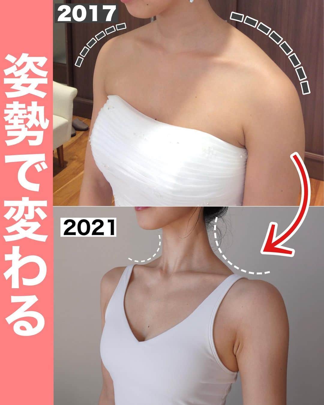 佐川裕香のインスタグラム：「\月額オンラインレッスンお申込み受付け開始🌸/   足のアーチ🦶が潰れ続けることは背骨にも影響.. もちろん画像のような、首・肩にも関係します  重力、床からの反力を味方に 力みなくリラックスしている状態こそが からだは楽で見た目のシルエットは美しくなります。  猫背の時にみっともない！ もっと姿勢正しなさいと言われ続けましたが、 それで解決しなかった私のように  身体の骨格、姿勢は“意識のみ“で解決できないからこそU-FIXでは構造を理解し、実践へ！  身体を整え・鍛え・繋げる3ステップ✨ 姿勢は改善する“過程“こそが大切だと感じます😊  身体も歯列矯正のように、時間はかかるけれど “習慣が変われば結果が変わる！“ 1年、2年後と大きな変化へ着実に繋げていきましょう🌱✨  @ufix_world  --------------------------------------------  ▶︎募集期間 →2/25(土)〜3/4(土)23:59まで‼️  プロフィールのURL、MOSHサイトから お申込み受付けさせて頂きます✨🌸  I begin the online lesson of the monthly basis system that I turned toward the world in few days! I am looking forward to what I can give lessons in together!🌍  --------------------------------------------  \お知らせ/ ●通常5週目はお休みですが 3月29日(水)『足・脚・整える✨』 特別レッスンを開催いたします！！  とても大切な内容となっております🌱 この機会にぜひ✨  @ufix_world   --------------------------------------------」