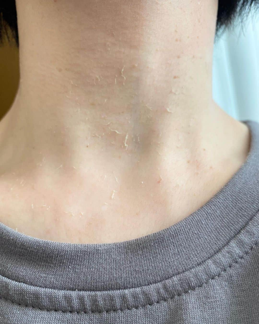 杉村理恵子さんのインスタグラム写真 - (杉村理恵子Instagram)「首アップです。。。生々しくてすみません  こちらは、トレチノイン塗って4日目の私の首です 昨晩散々剥けましたが、今朝もまた新たに剥けています これだけでも一週間でお肌がつるつるピカピカになります さらに、トレチノインの後セルラムすると、びっくりするくらいきれいになる！シワも薄くなります  しかし。。。イボは残念ながら取れません。  先日セルラムで教えて頂いた、ゴールド三養茶を試し中。 なんと！このお茶でイボが取れたらしい！ レーザーだと跡が消えるまで1年かかかってしまうので、お茶で取れるなんて魔法があるなら、高ーいお茶だけど頼りたい  イボの他にも、ハトムギ効果でお肌が白くなったりニキビにも効果があるそう！  私も透明感はすぐ感じましたよ  商品をタグ付けしたかったんですが。。。 残念ながらなかった、楽天とかにも売ってます。  トレチノイン1ウィーク完結皮剥きケアの 動画をアップしていますので、プロフィールからYouTubeへ飛んでみてください  #首 #首イボ  #首のシワ  #ゴールド三養茶  #トレチノイン #セルラム」2月27日 13時32分 - hair_make_osugi