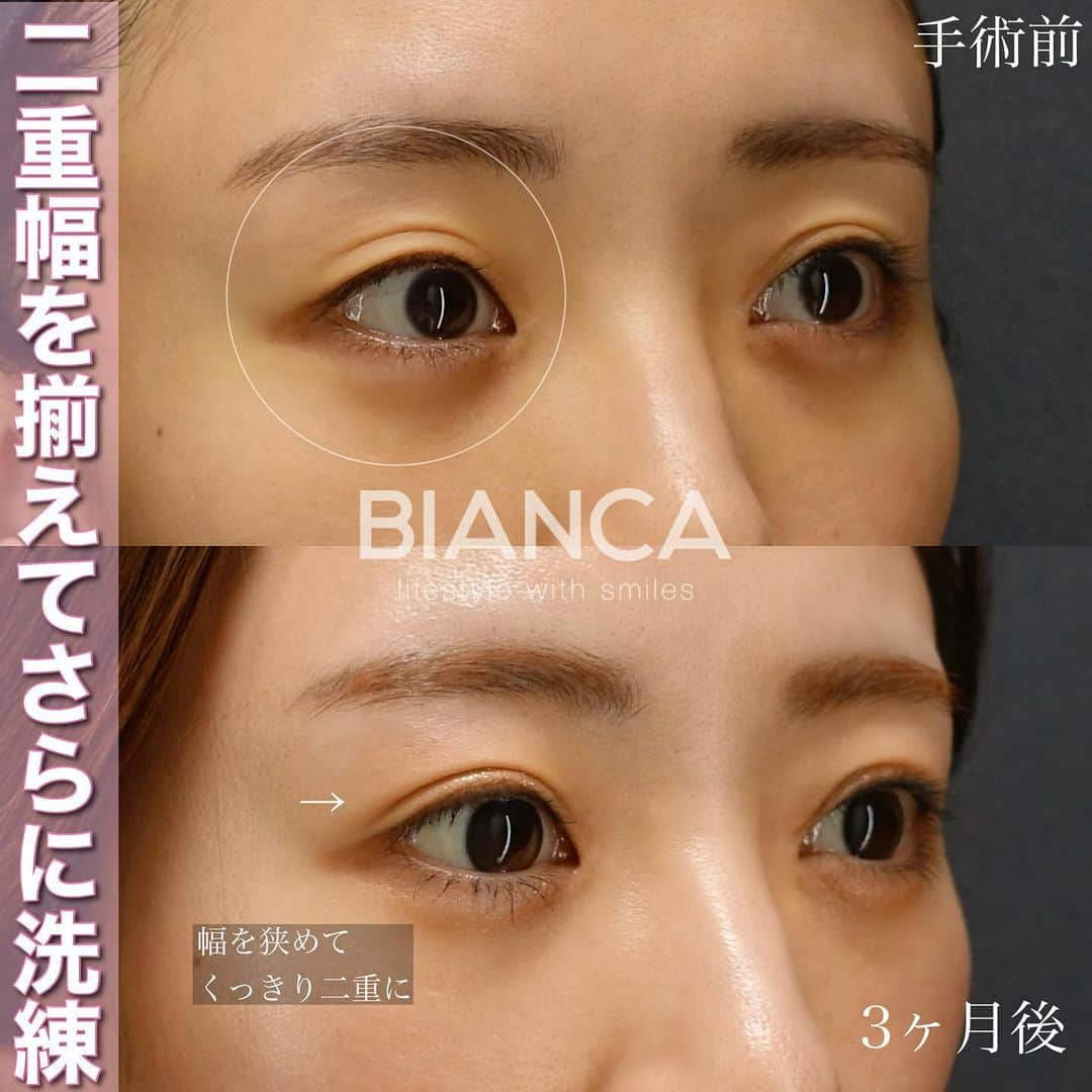 辻沢由有（BIANCA CLNIC 表参道院 院長）さんのインスタグラム写真 - (辻沢由有（BIANCA CLNIC 表参道院 院長）Instagram)「#dryuu目　#dryuu二重  ▶︎swipeで文字なし&別角度症例写真▶︎  二重幅が広すぎると逆に眠たく見えます😳 過去の埋没を抜去した上で幅を狭め、よりくっきりとしたラインへ。そして目の開きもよくなったのでより目が大きく見えますね。  上　術前 下　術後3か月  MT法は、特殊な極細⽷でまぶたの裏側の筋⾁を縫い縮めることで⽬の開きを良くする⼿術です。  🌸瞼の開きが悪く⿊⽬が隠れる 🌸眠そうに⾒える 🌸⽬つきが悪いと⾔われる  現在、お得なモニター様も募集しています。 私も適応かも？と思った方は、 一度ぜひカウンセリングにお越しください✨  💉眼瞼下垂（MT法） 💴税込365,580円 😷腫れ 内出血:数日〜1週間程度  *⑅୨୧ ----------------------- ୨୧⑅*  お肌•注入•お手術まで全て担当できます🥰 「何をして良いかわからない」 「ガッツリ変わりたい」「自然な変化が良い」etc...なんでもご相談ください✨  📝ご予約はwebが便利です✨ プロフィール欄のリンクからご予約ください。 ※医師指名可能（“大久保医師指名”をクリック） ※診察料はかかりません🙅‍♀️ ※表参道院勤務が9割となっています。  📍BIANCA CLINIC ※お電話頂くと自動音声通話に繋がります。 ✔︎表参道院 ☎️05018071593 東京都港区南青山5-11-10  南青山511ビル 2F ✔︎銀座院 ☎️05031964834 東京都中央区銀座1-5-6 銀座レンガ通り福神ビル 4F •診療時間 10:00〜19:00 •年中無休（年末年始を除く）   #二重切開 #二重埋没 #二重整形 #埋没法#二重埋没法 #タッキング #切らない眼瞼下垂症手術 #切らない眼瞼下垂 #MT法 #眼瞼下垂手術 #眼瞼下垂 #くぼみ目 #くぼみ目改善」2月27日 13時48分 - i_am_yuu__