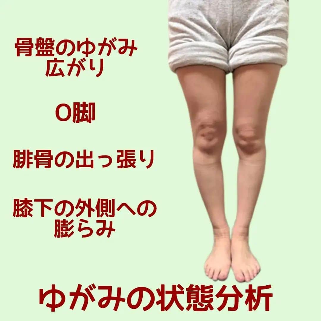 中目黒整体レメディオ 院長　渡邉潤一のインスタグラム：「画像の脚の状態について説明していきます。  骨盤部は、右が後ろに捻れ、左が前に捻れており、それにより骨盤全体が広がっている状態   足のラインはO脚状態にあり、膝は軽度の内巻き膝   膝下は腓骨が出っ張っていることで 外側へ膨らんでいる  ーーーーーーーーーーーーーーーーーーーーー  この方は軽度の側湾（側彎症に該当しない）があります。  側弯の特徴である骨盤が前後に潰れていて、一般的な骨盤よりも少し外側に広がる楕円形になっています。 ですので、もともと大転子が張り出しています。  その状態の上に、さらに骨盤のゆがみにより大転子の出っ張りが起こっているので、より大転子が目立ってしまっています。  また、骨盤が楕円形の方は股下（恥骨周辺）が普通の状態よりも開いている事が多いです。  なので、施術により膝をくっつけてしまうとかえってX 脚のようになり、膝下が目立ってしまい、脚の形が悪く見えてしまいます。  施術は、骨盤を整える・大転子を引っ込める・膝下の膨らみの原因の腓骨を引っ込める事を中心に行います。  このタイプは、一般的な骨盤体操やトレーニングでは、なかなか結果に結び付きにくいので、上記の事を踏まえて、アプローチを選んでください。  同じような骨格、脚のラインの方は、ご自身のゆがみの状態把握の参考になさってみてください。 もちろん、ご自身で分からなければ、ご来院ください。 詳しく、状態をご説明させていただきます。  . . . ーーーーーーーーーーーーーーーーーーーーー  💮施術のご案内💮 中目黒整体レメディオ：骨盤・美脚コース 施術をご希望の方は、HPの予約フォームか、 お電話（0357735977）にてご連絡ください。  ーーーーーーーーーーーーーーーーーーーーー  #大転子 #大転子矯正 #o脚矯正 #x脚矯正 #膝下o脚 #XO脚 #骨格矯正 #骨盤矯正 #産後骨盤矯正 #下半身太り #下半身痩せ #太もも痩せ #ふくらはぎ痩せ #反り膝  #反り腰 #骨盤の歪み #整体 #レメディオ #姿勢矯正 #整体サロン #骨格診断」